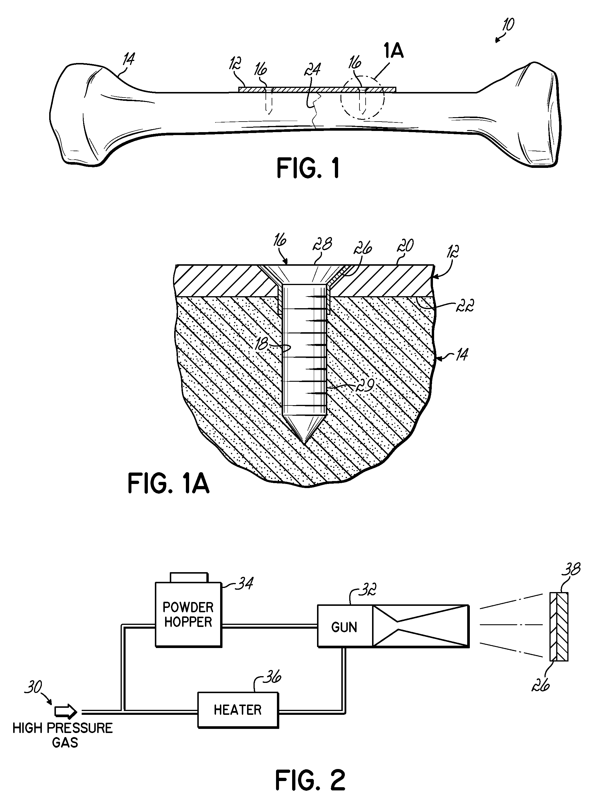 Bone fracture fixation system