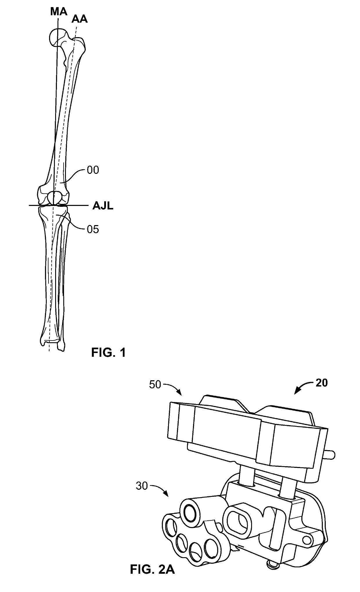 Globalized total knee instrumentation