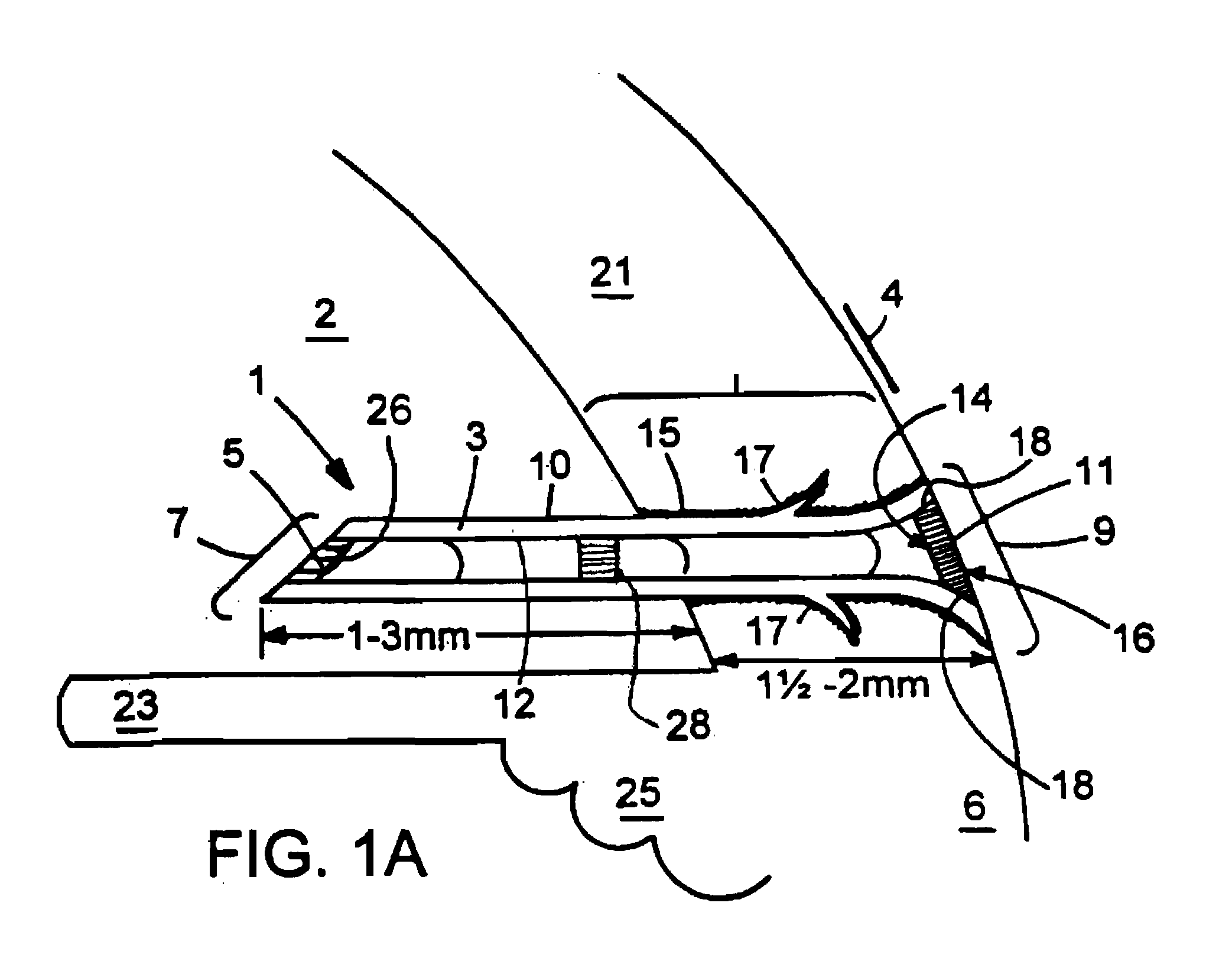 Glaucoma Treatment Devices and Methods