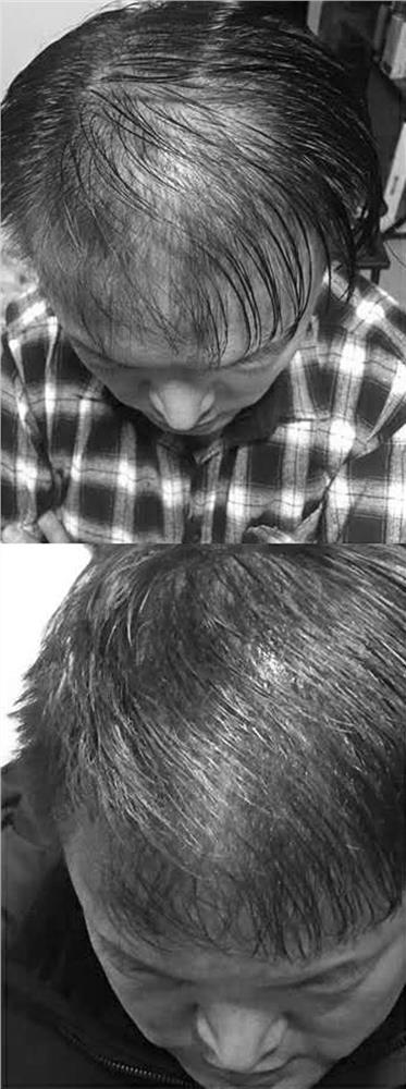 Anti-hair loss shampoo and preparation method and application method thereof