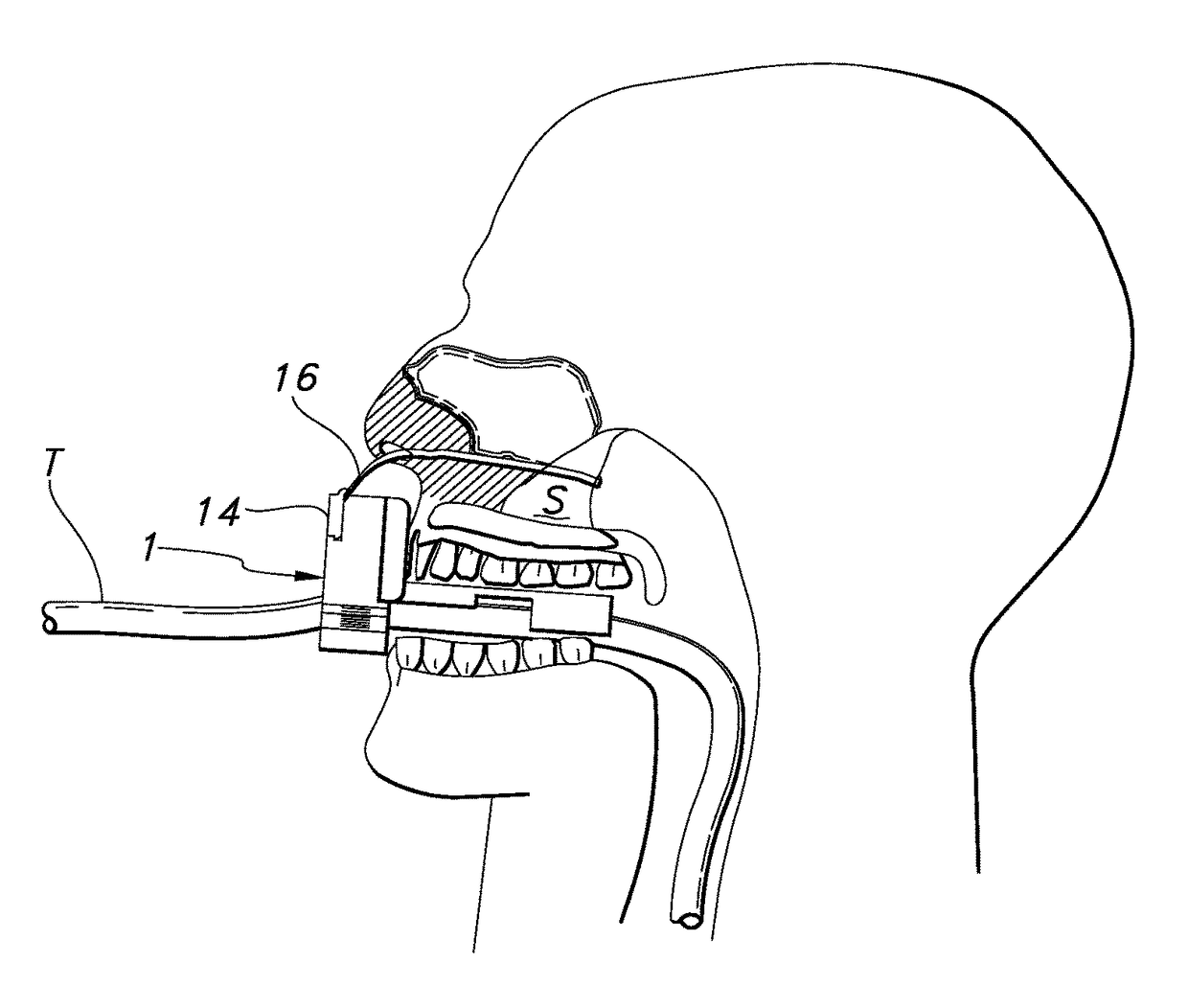 Device for securing an oral tube in a patient