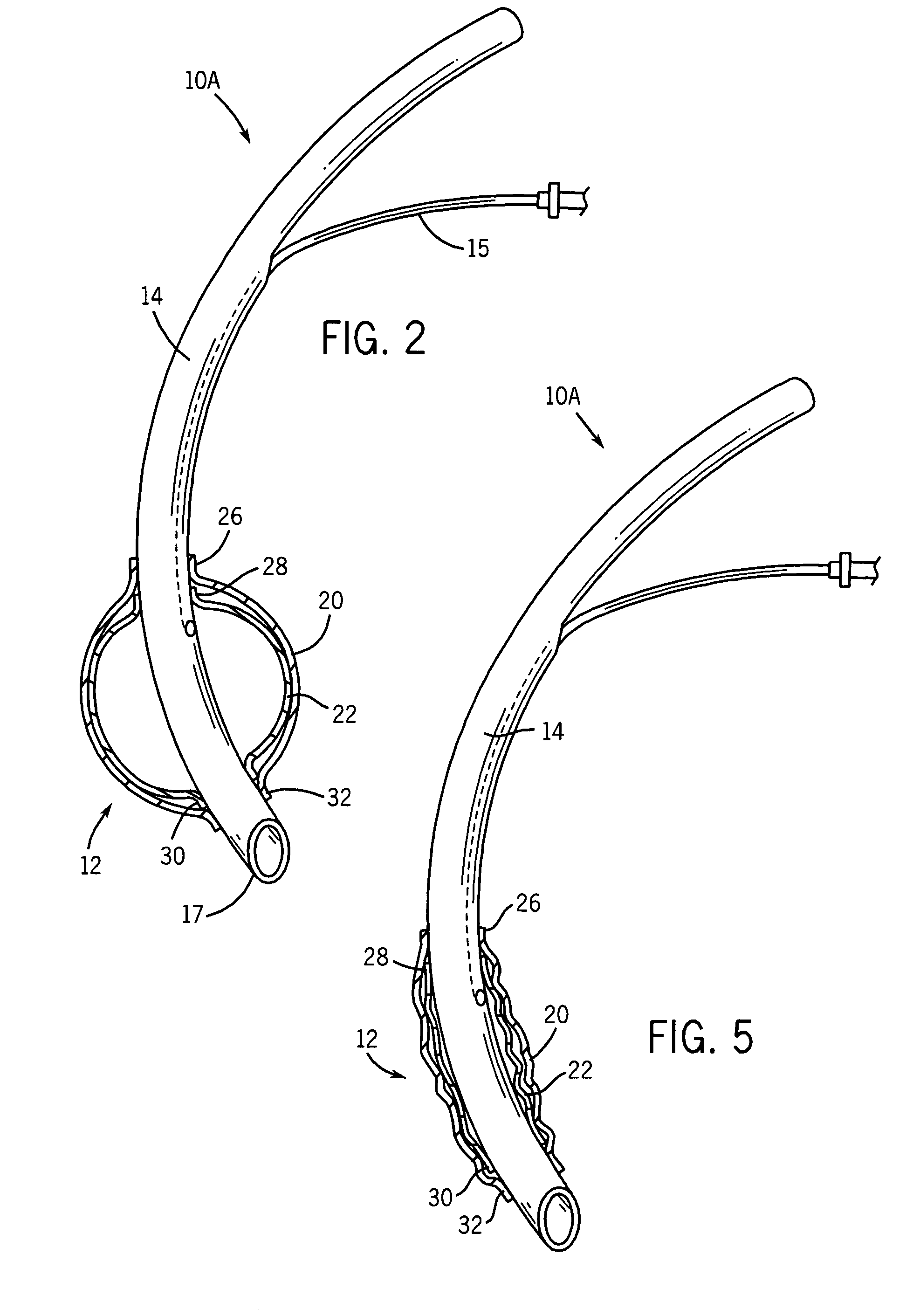 Endotracheal cuff and technique for using the same