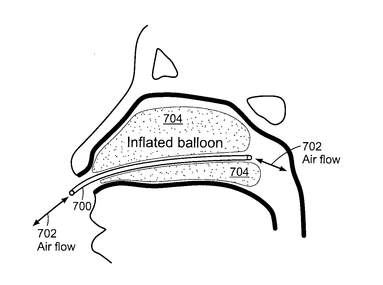 Toroidal balloon for external or internal compression with unique insertion or removal