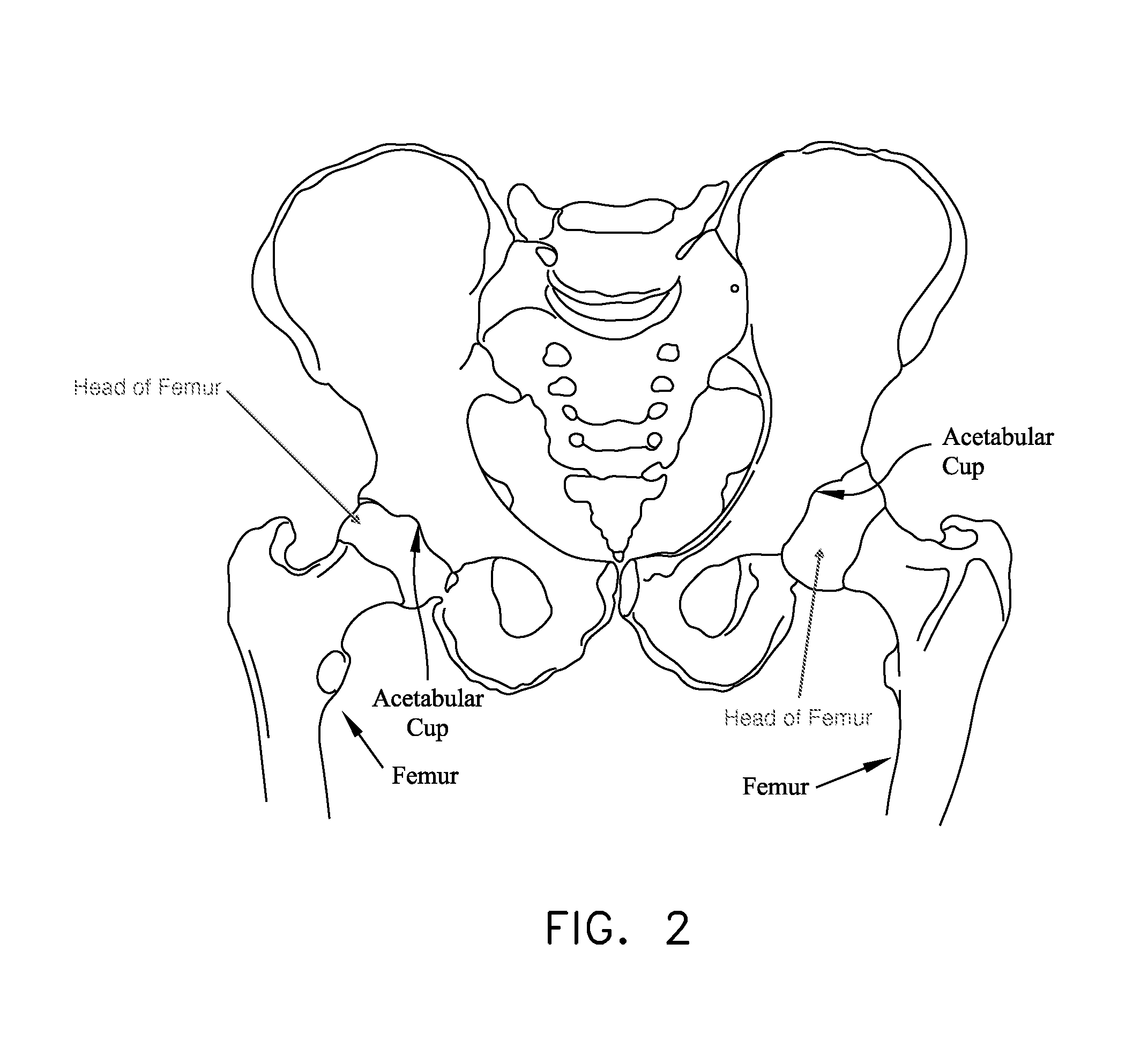 Laterally-expandable access cannula for accessing the interior of a hip joint