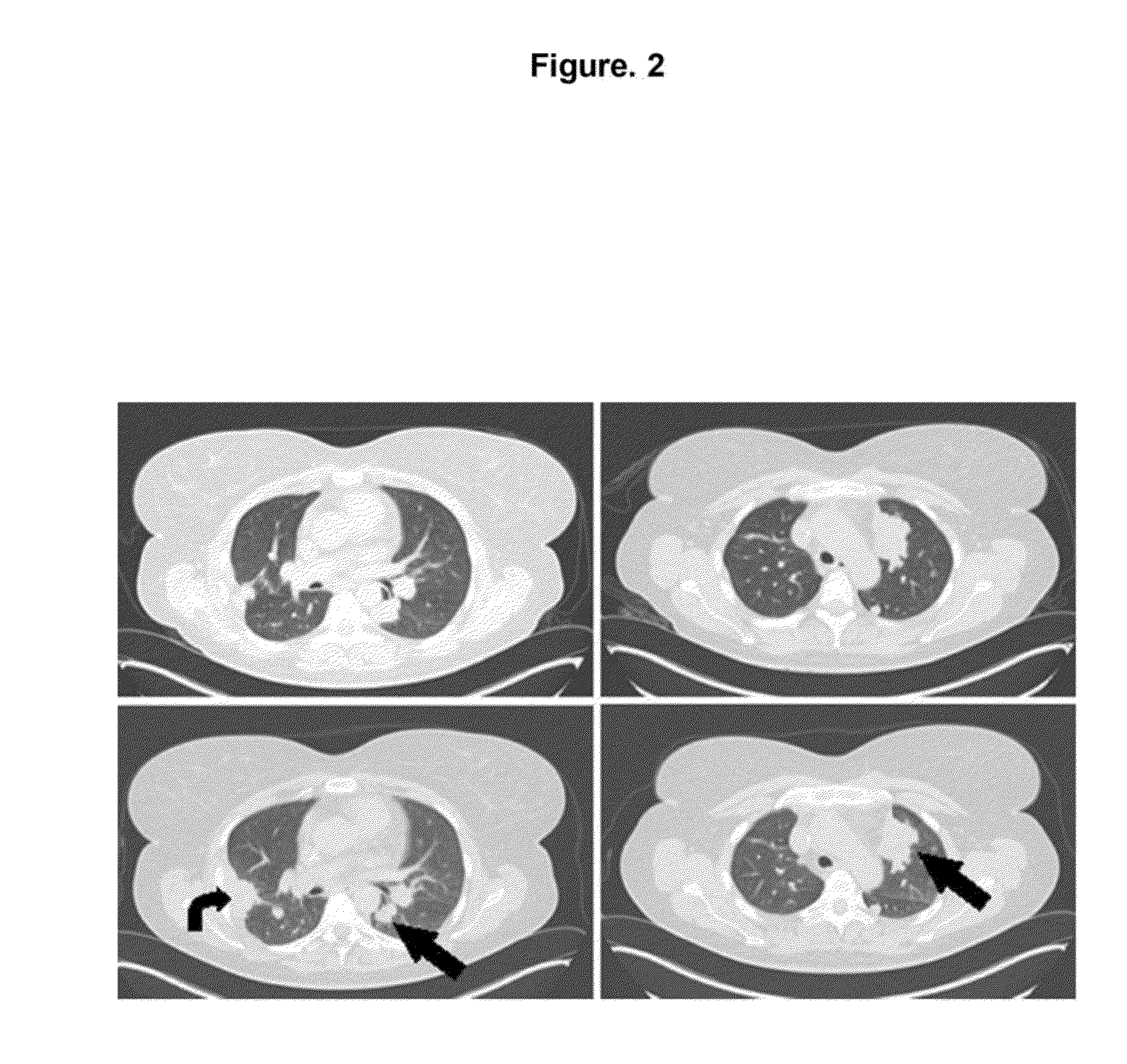Method for Treating Lung Carcinoma