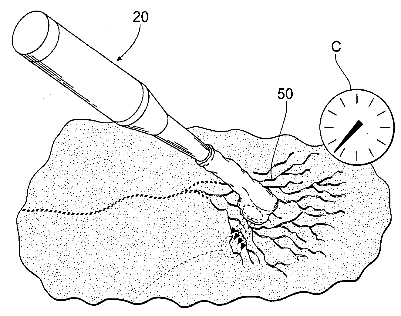 Systems and methods for treating superficial venous malformations like spider veins