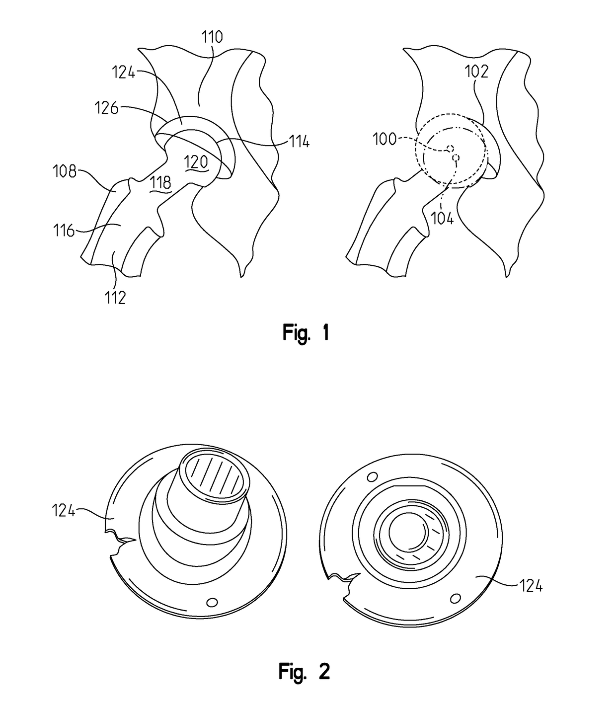 Anatomical concentric spheres THA