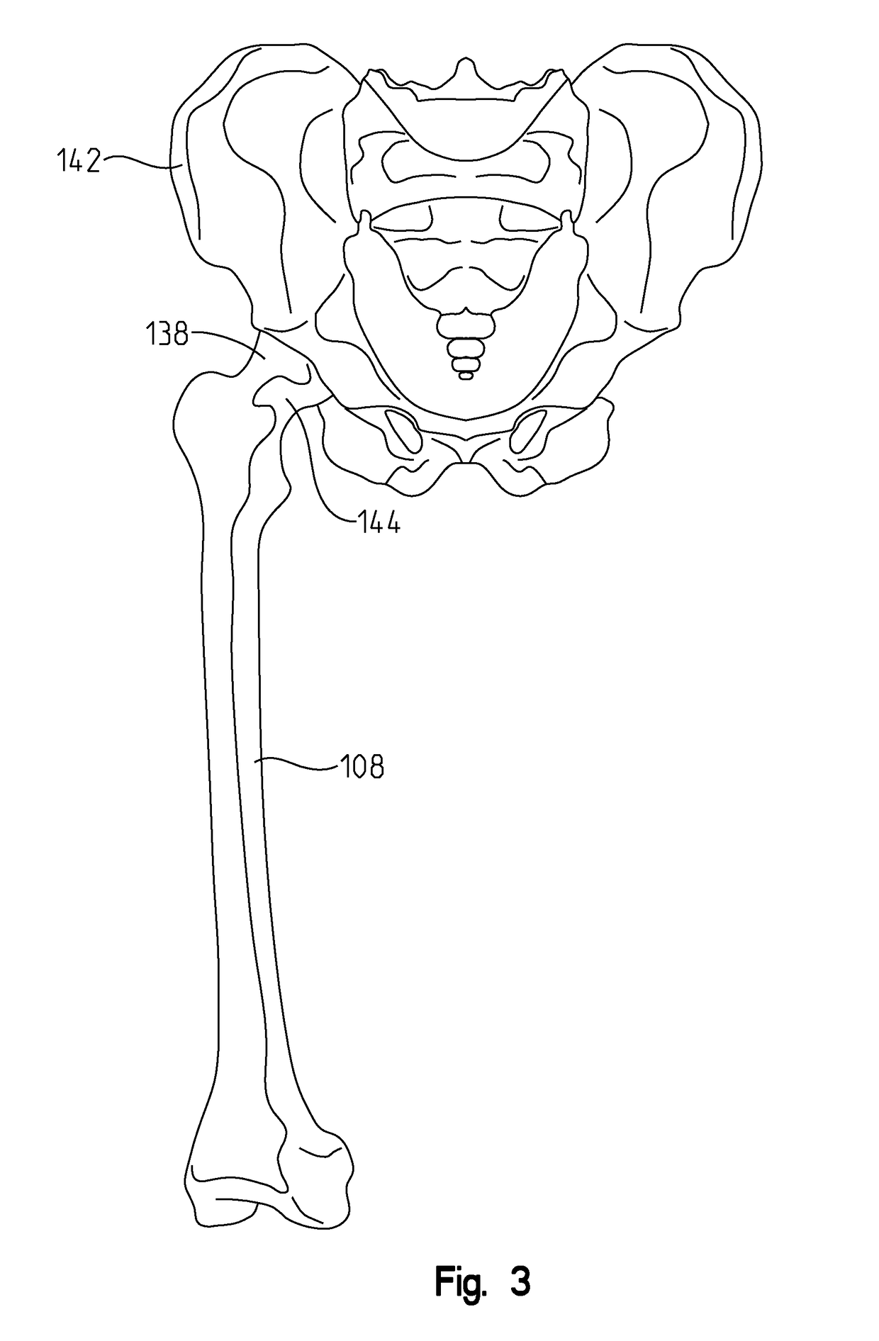 Anatomical concentric spheres THA