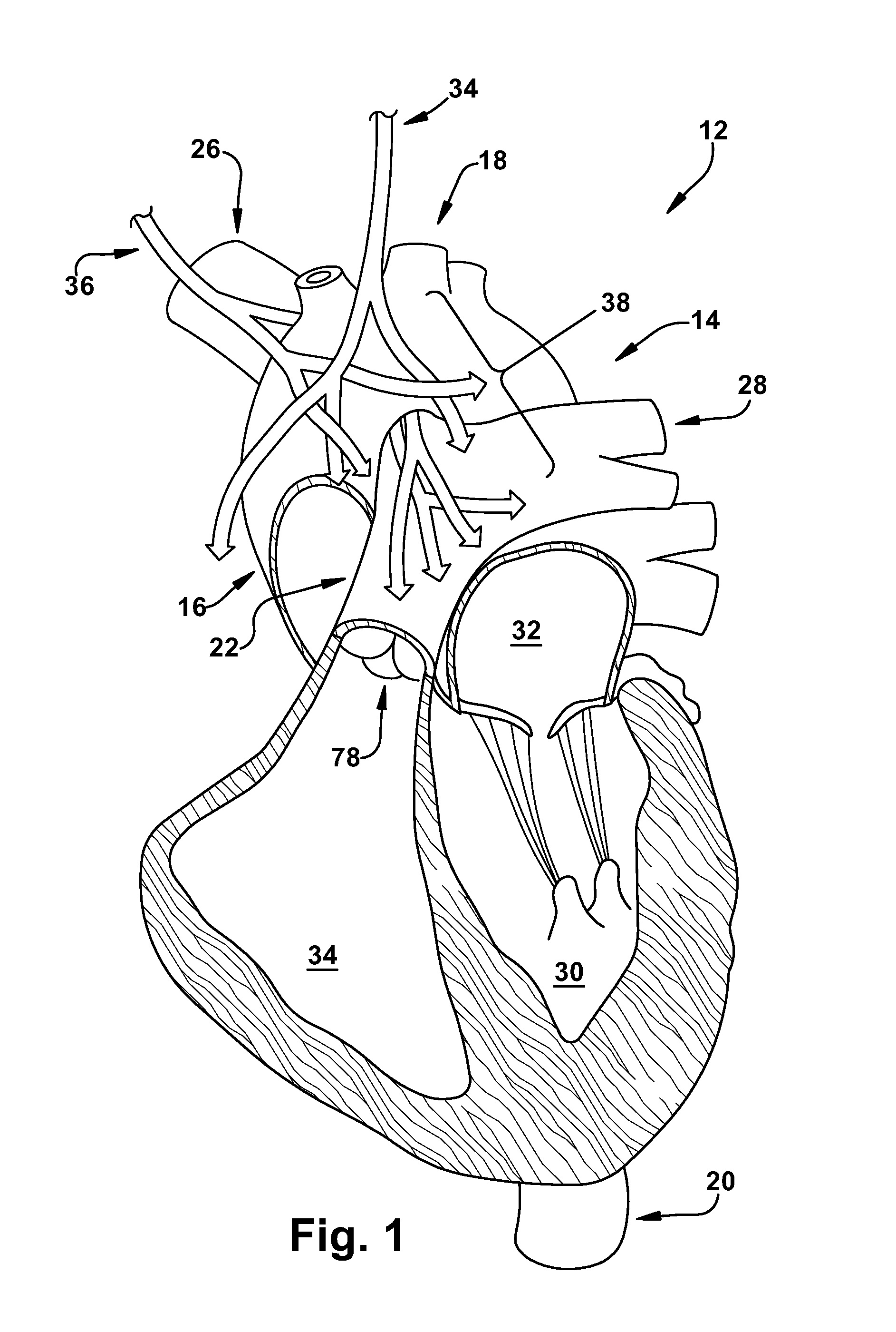 Device, system, and method for modulating cardiac function