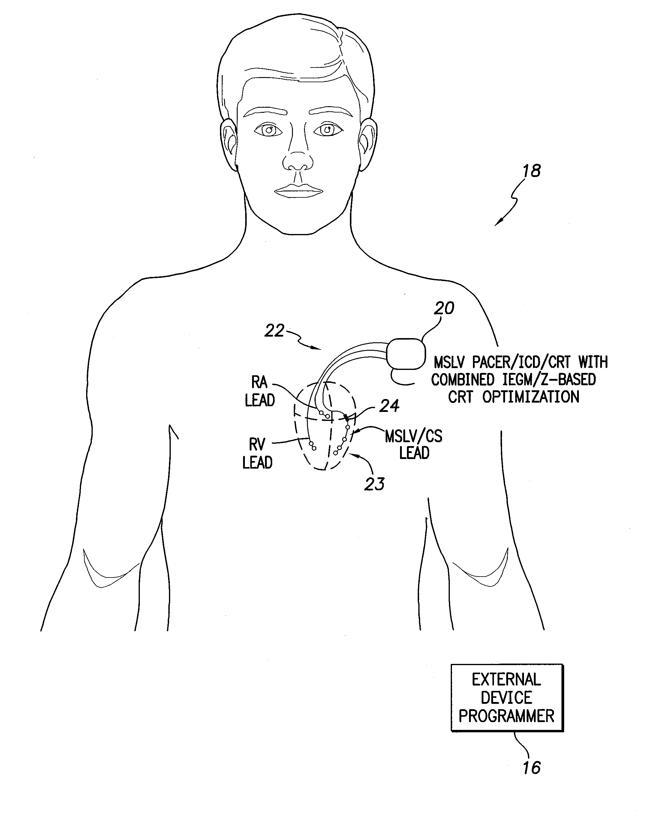 Systems and methods for optimizing AV/VV pacing delays using combined IEGM/impedance-based techniques for use with implantable medical devices