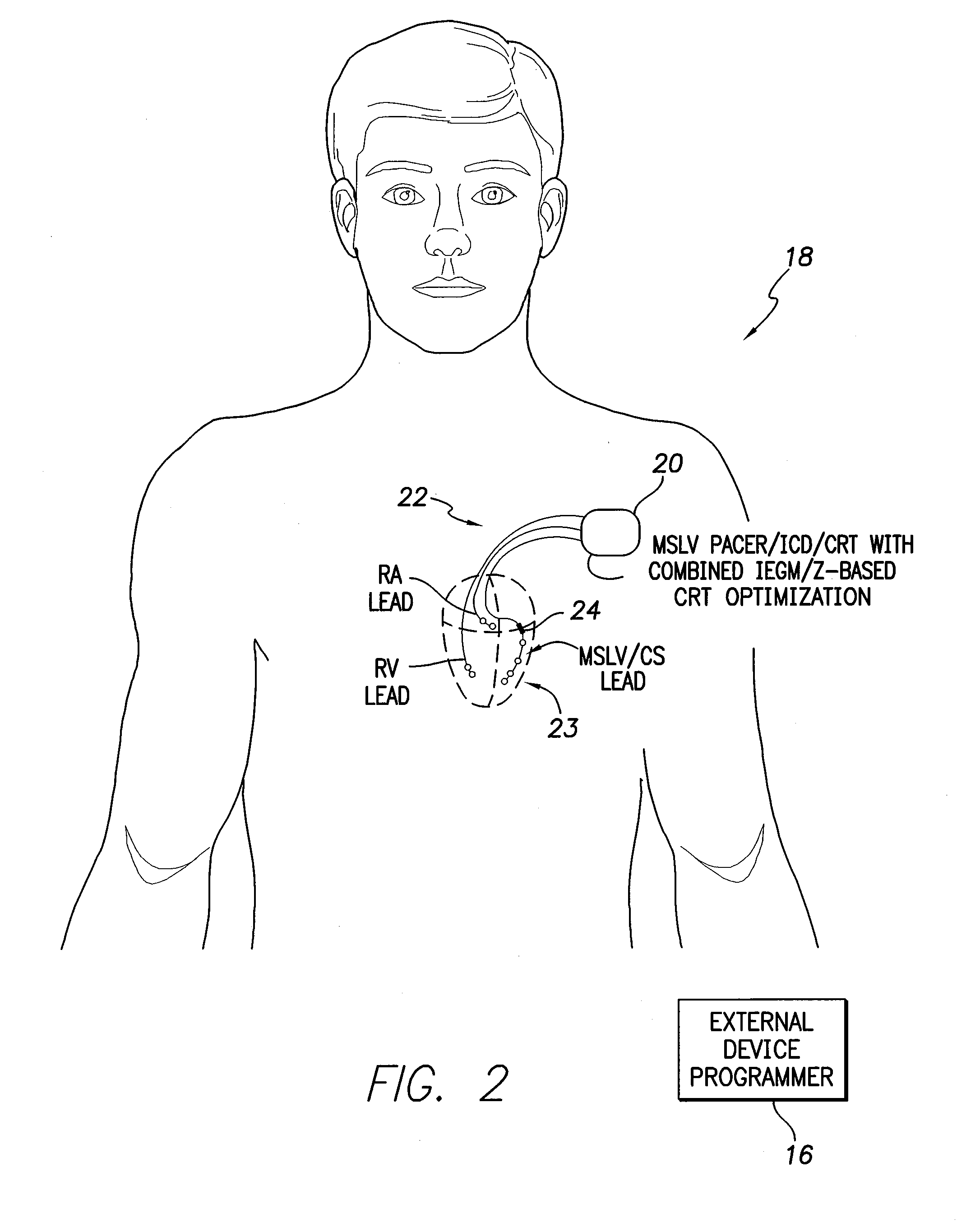 Systems and methods for optimizing AV/VV pacing delays using combined IEGM/impedance-based techniques for use with implantable medical devices