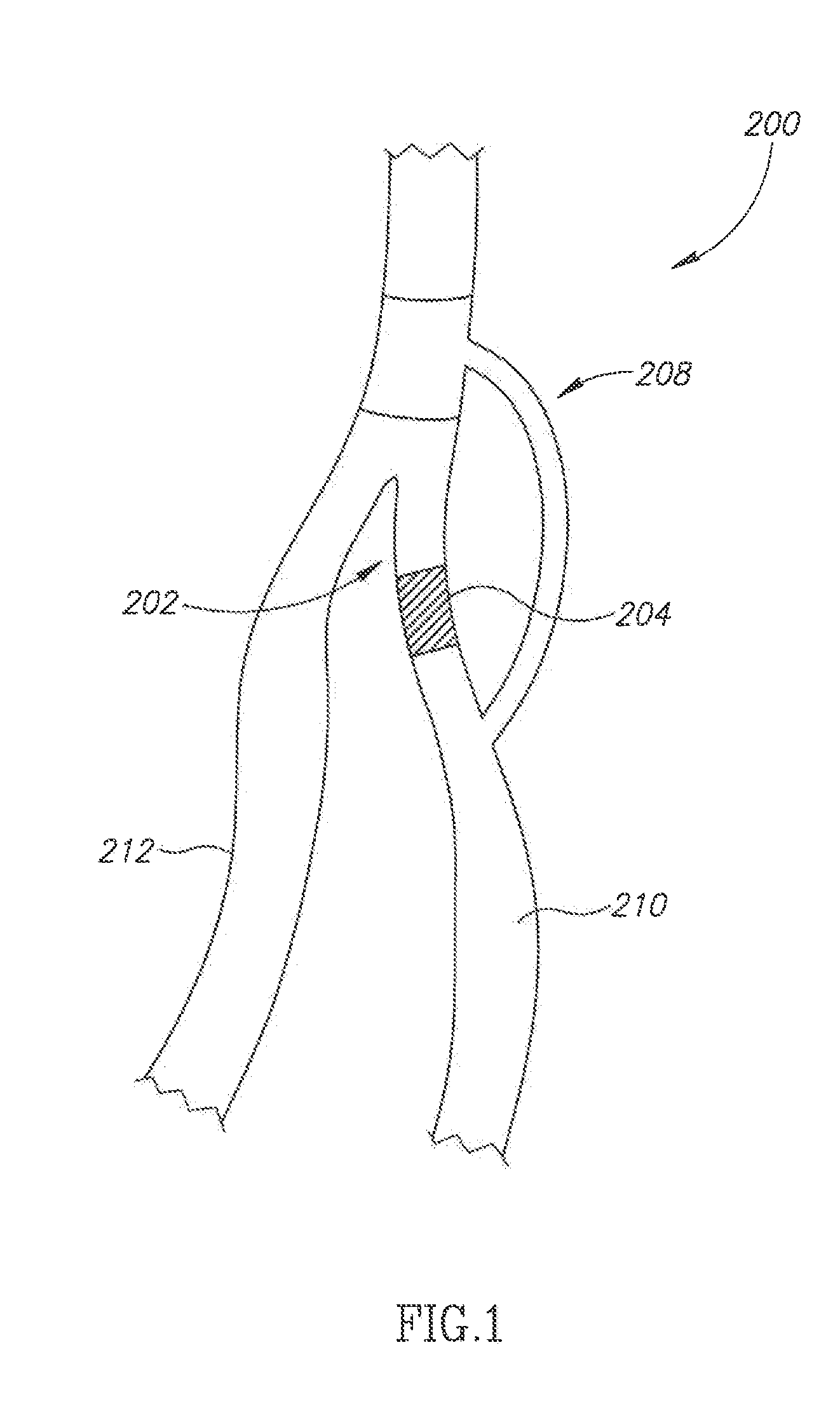 Bypass graft device and delivery system and method