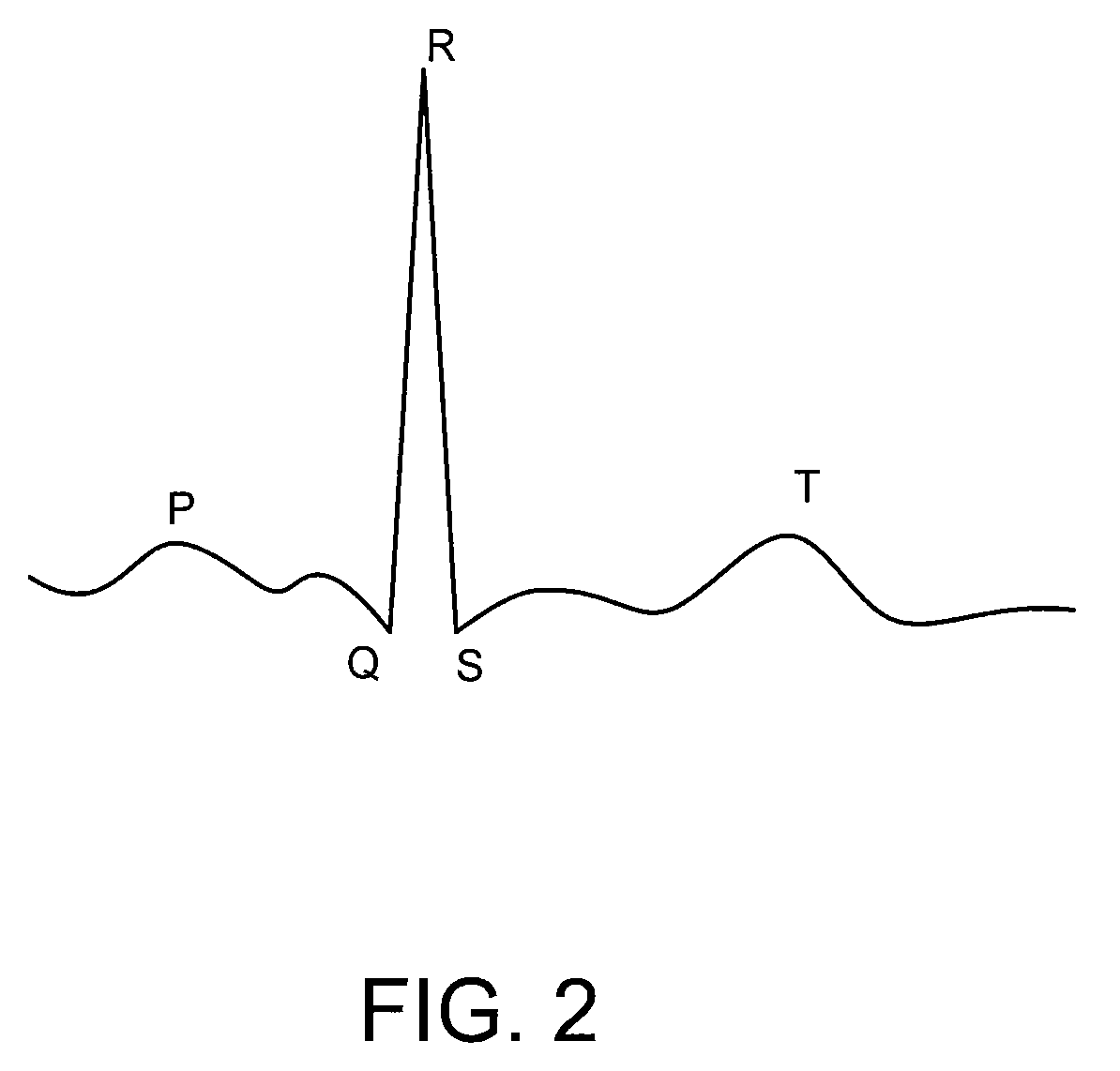 Systems and methods for detection of VT and VF from remote sensing electrodes