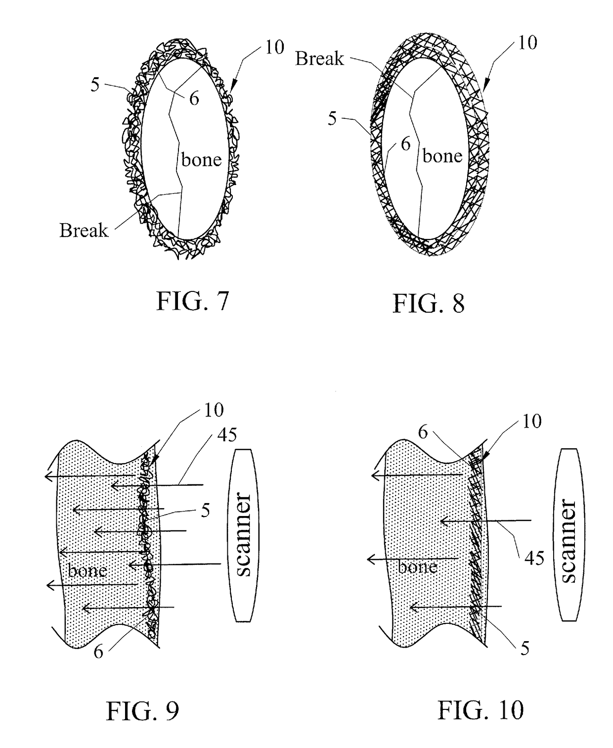 Implantable Metallic Sheet for Bone Repair