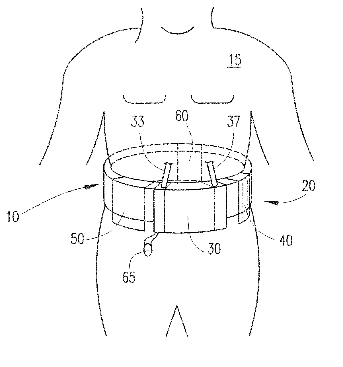 Wearable continuous renal replacement therapy device