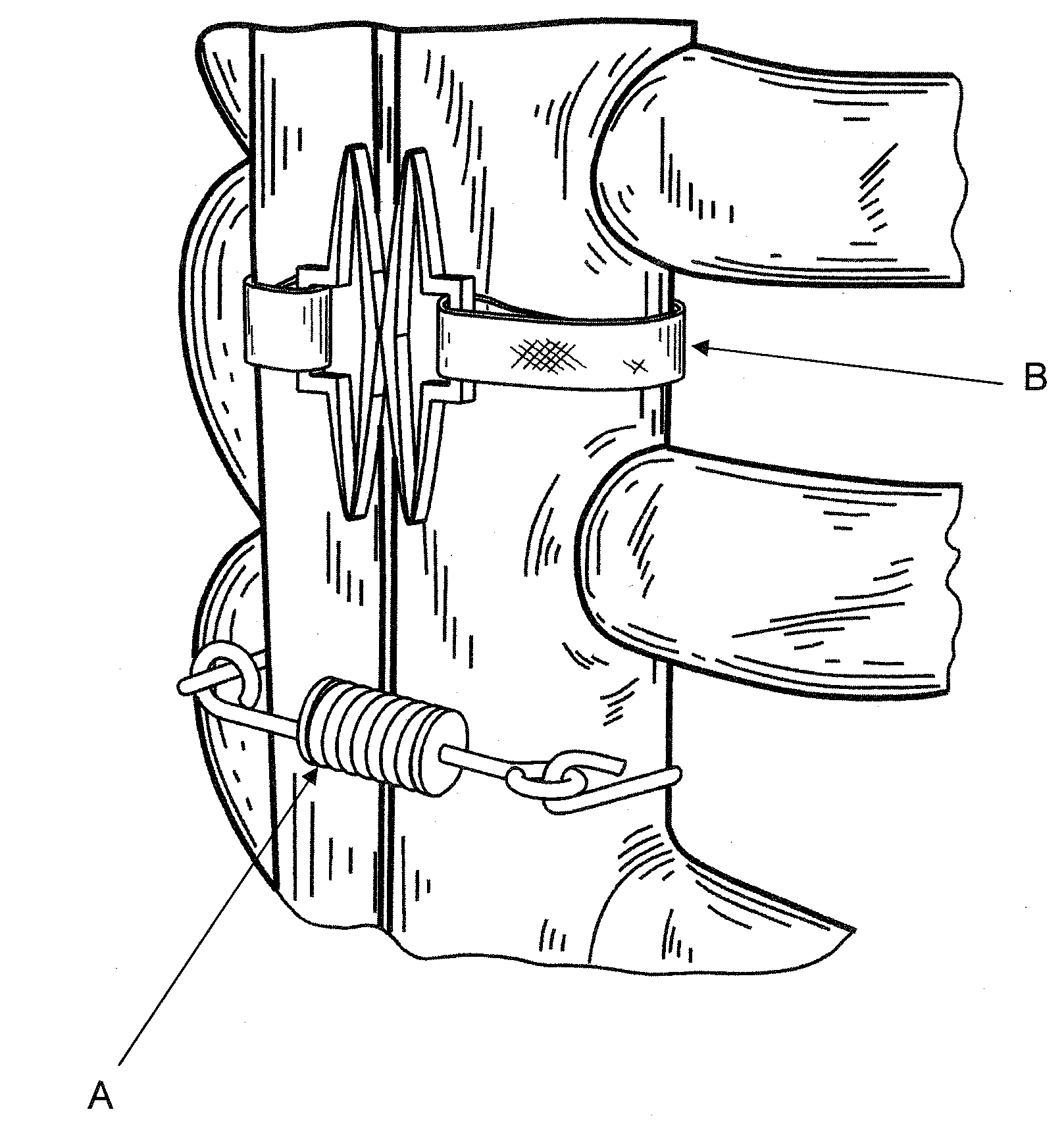 Flat suture banding system and methods