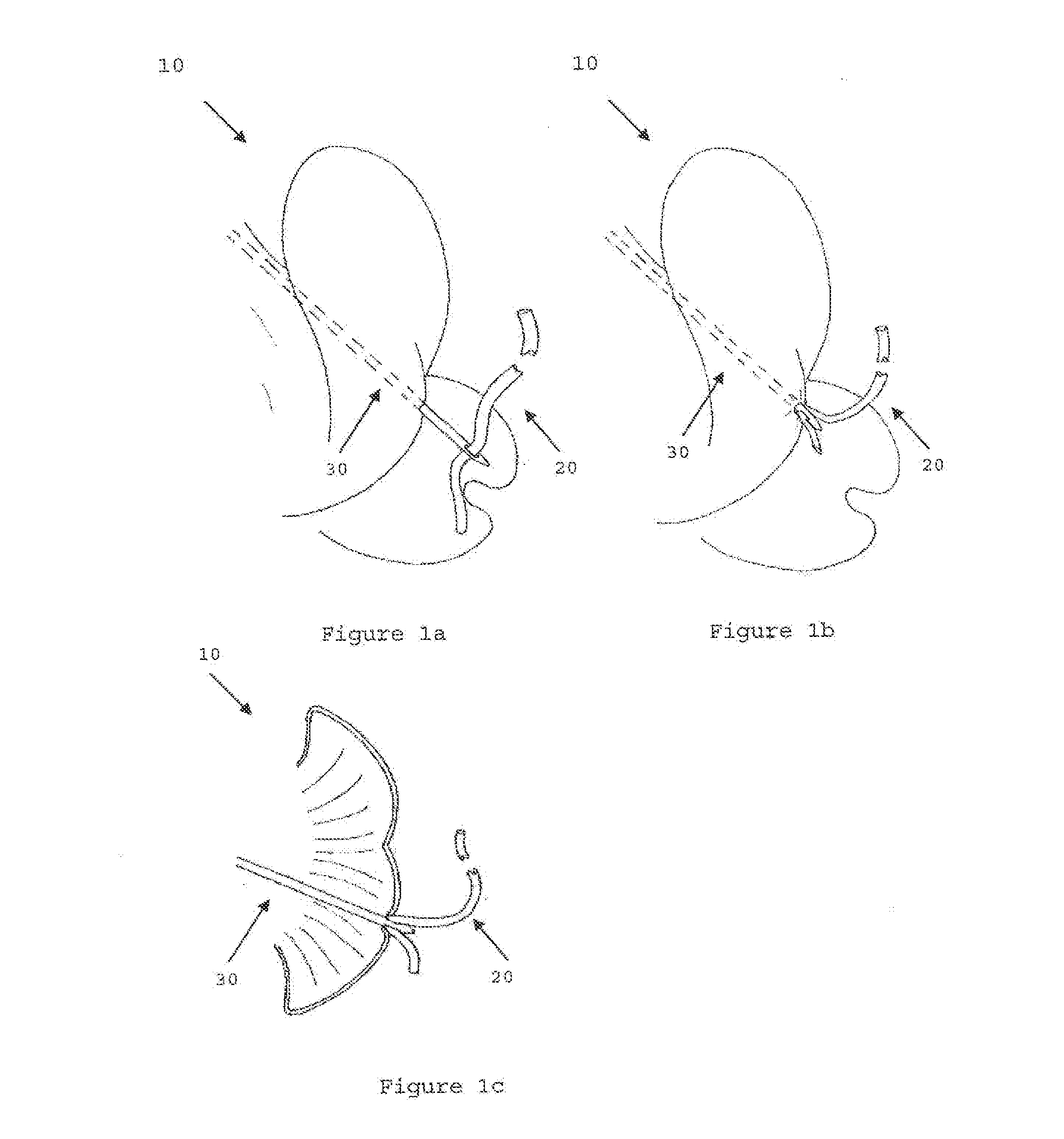 Modular Tissue Securement Systems