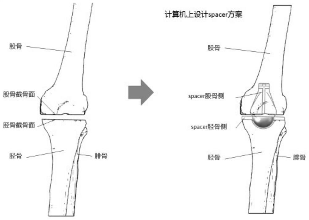 A kind of knee spacer and preparation method thereof