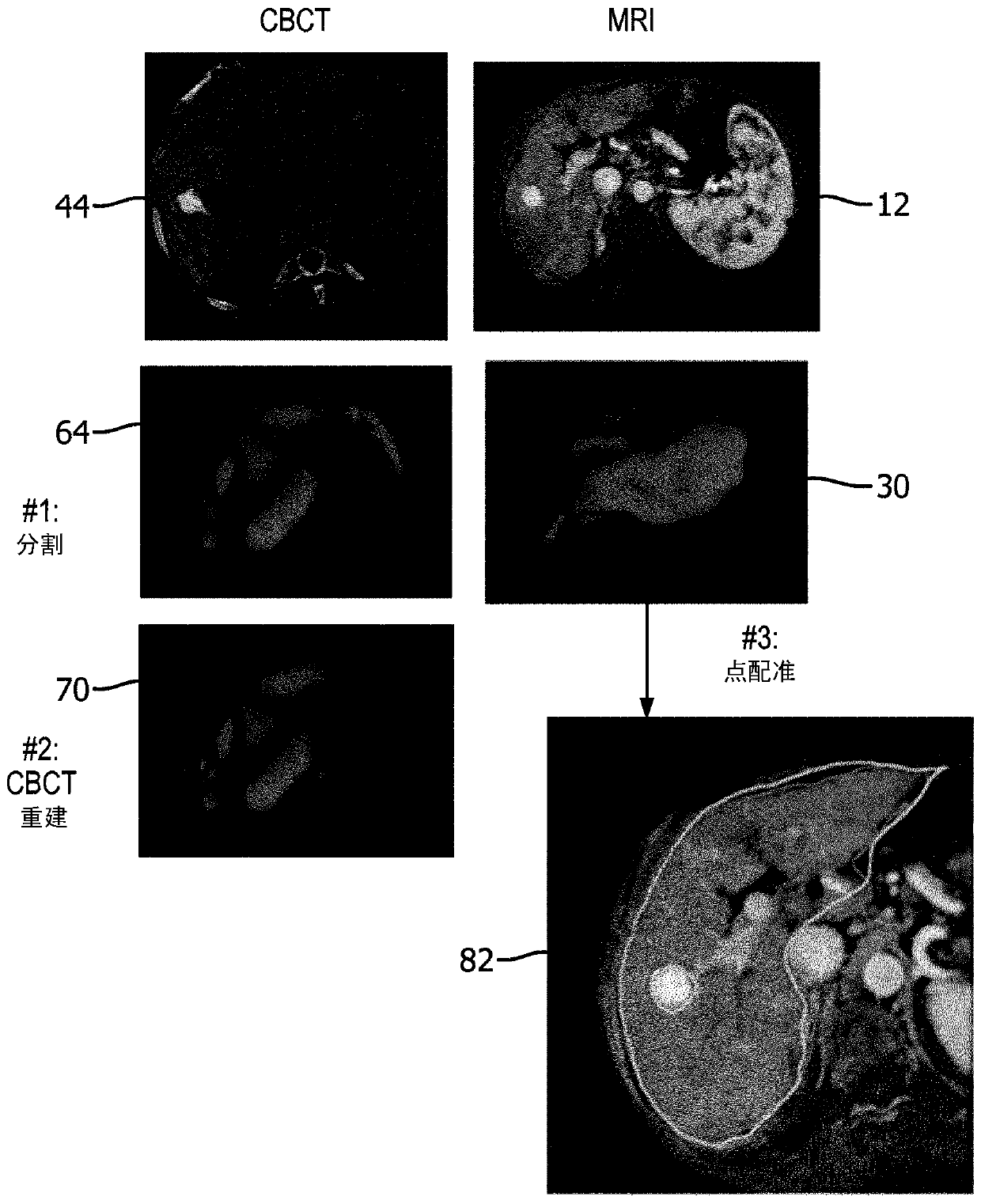 Cbct to mr registration via occluded shape reconstruction and robust point matching