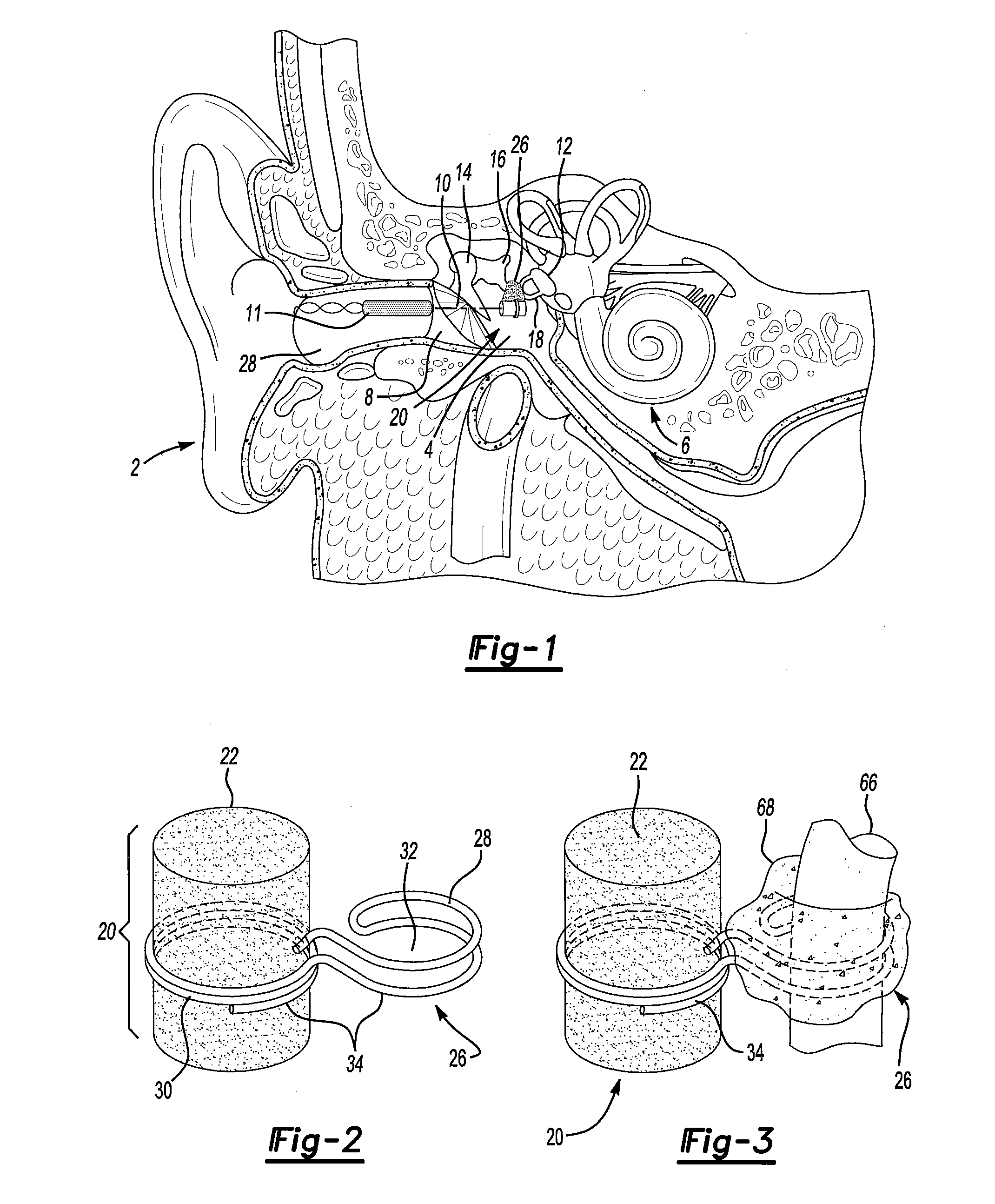 Middle ear implant and method