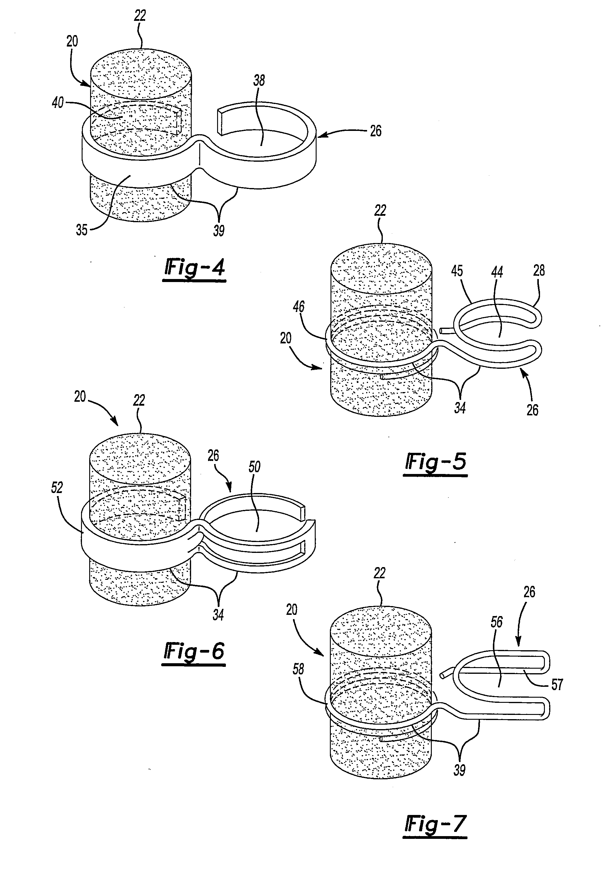 Middle ear implant and method