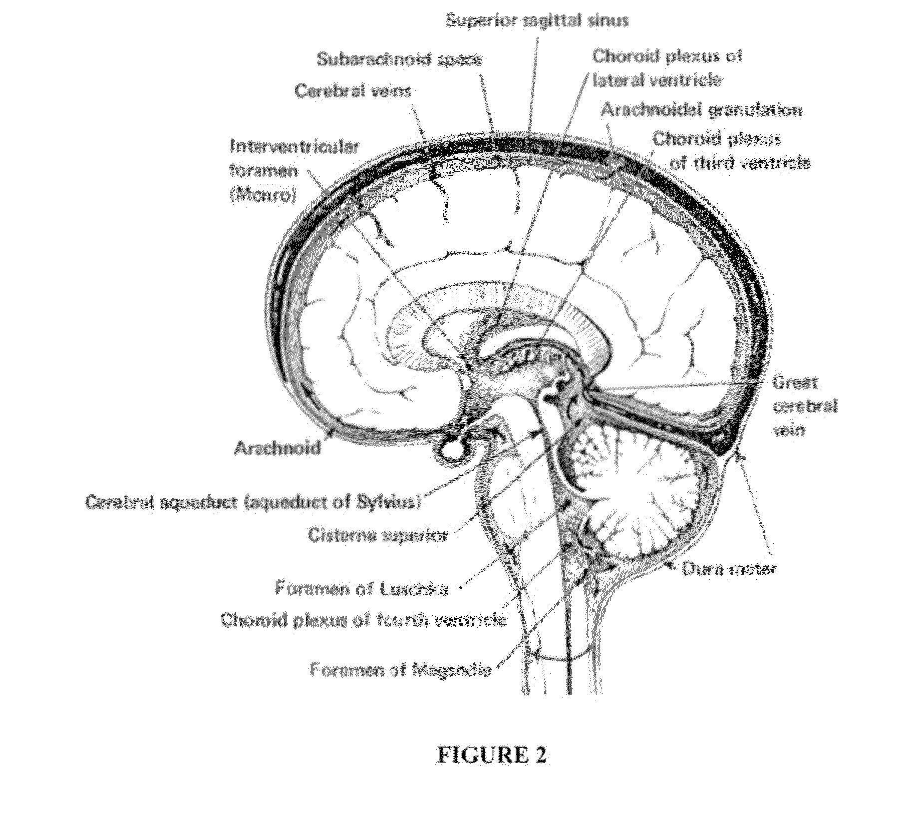 Intraventricular drug delivery system for improving outcome after a brain injury affecting cerebral blood flow