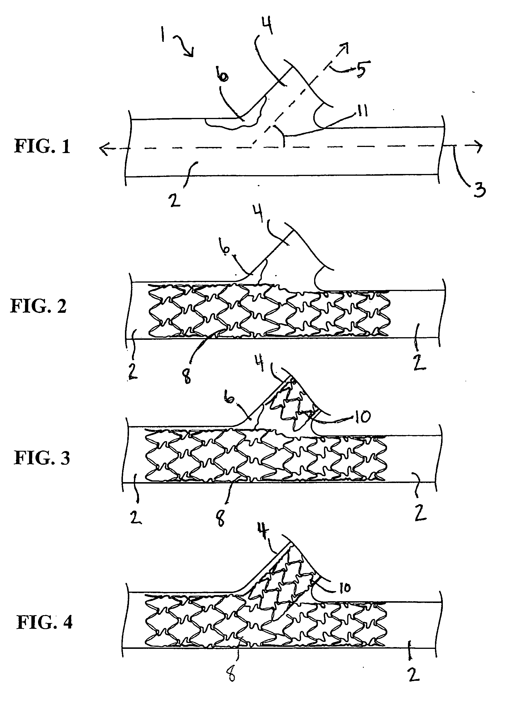 Stent with protruding branch portion for bifurcated vessels