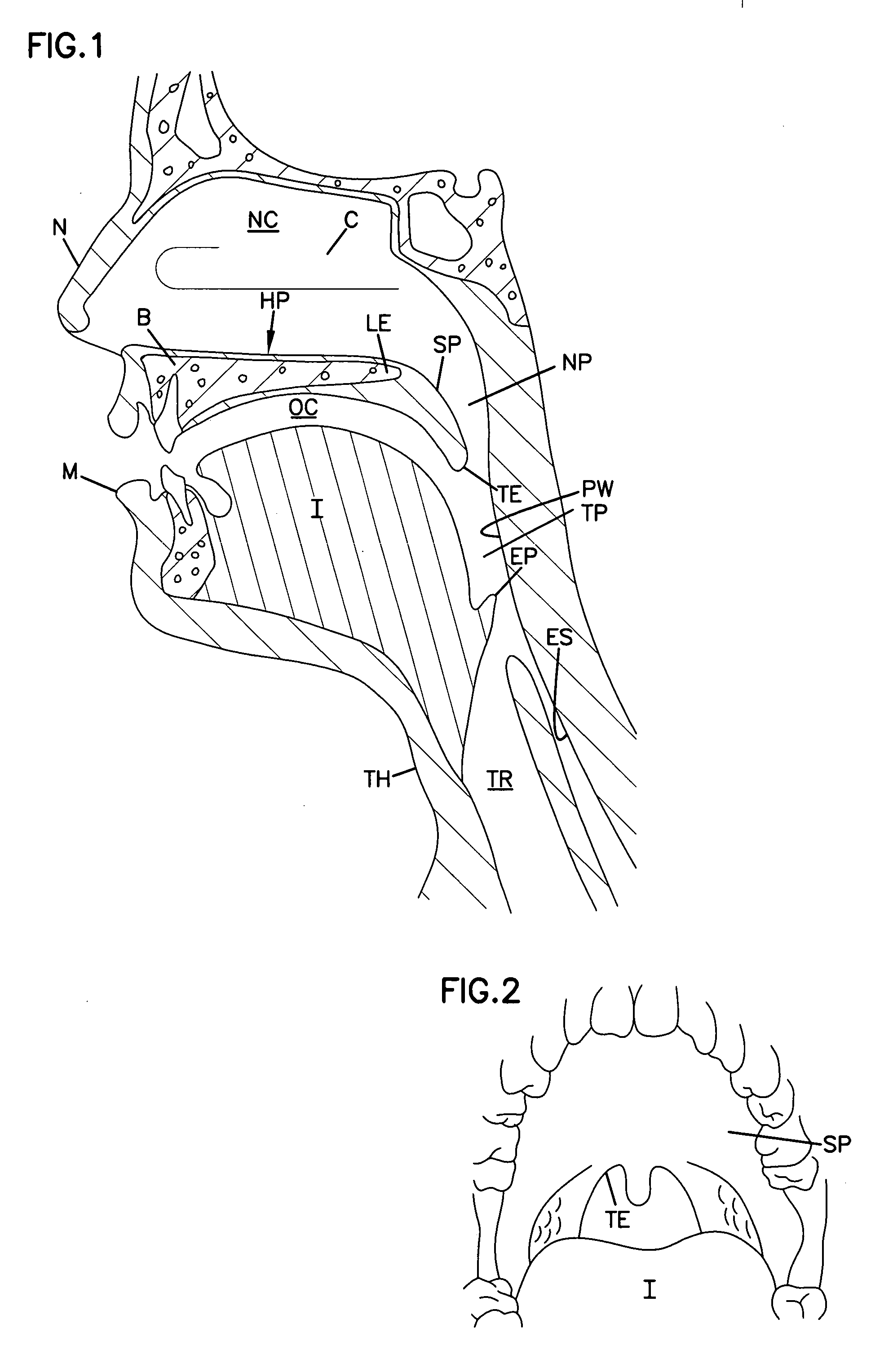 Airway implant and delivery tool