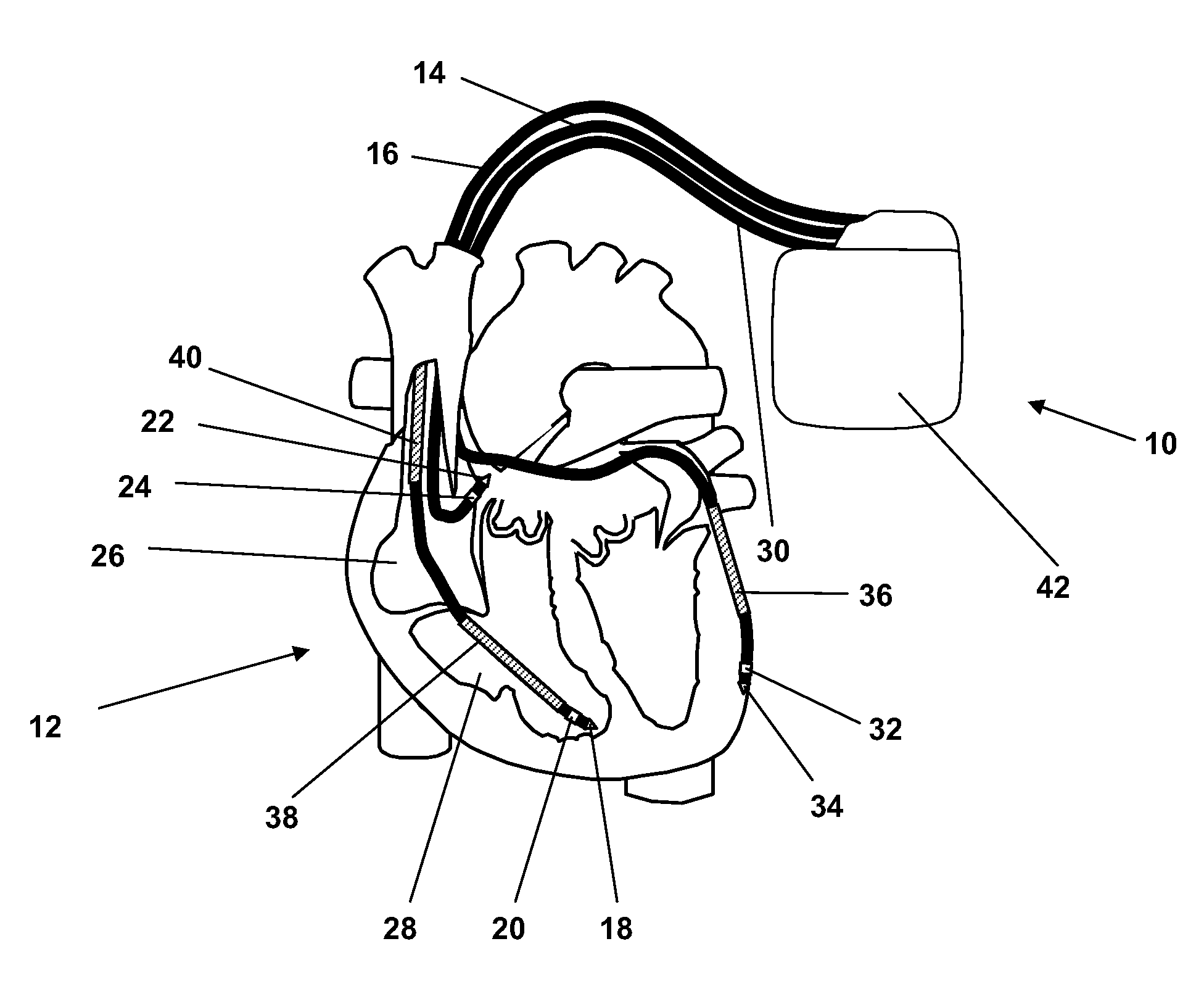 Antitachycardiac stimulator