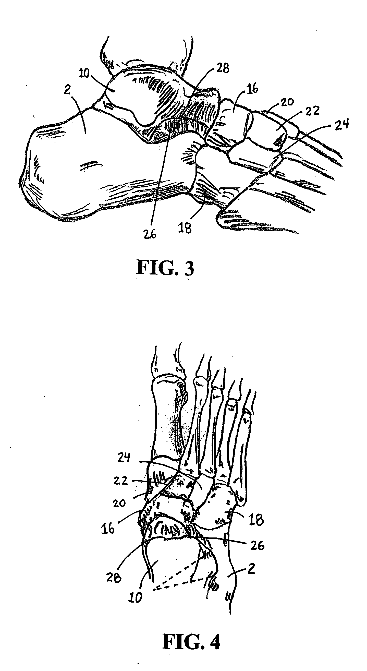 Catheter deliverable foot implant and method of delivering the same