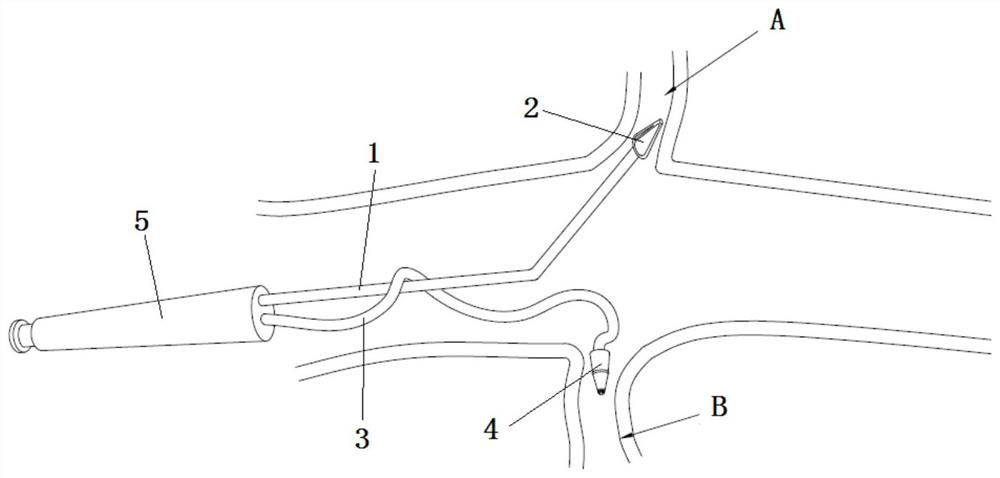 A double-headed coronary direct perfusion tube