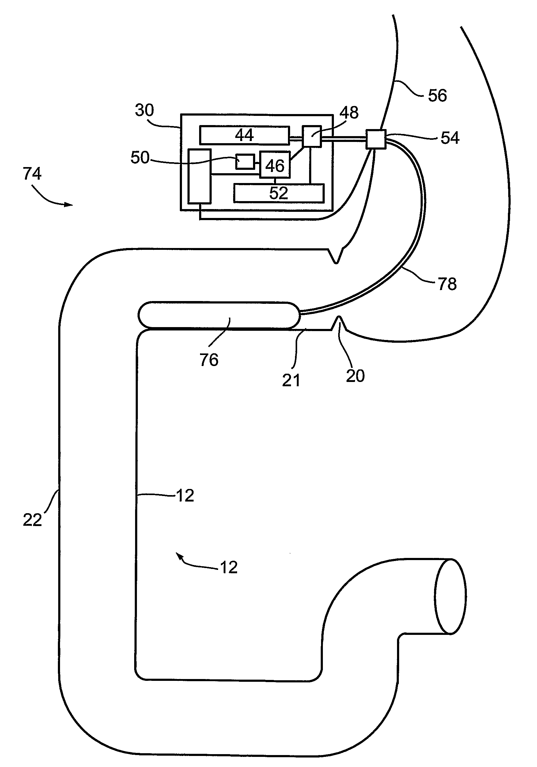 Duodenal stimulation devices and methods for the treatment of conditions relating to eating disorders