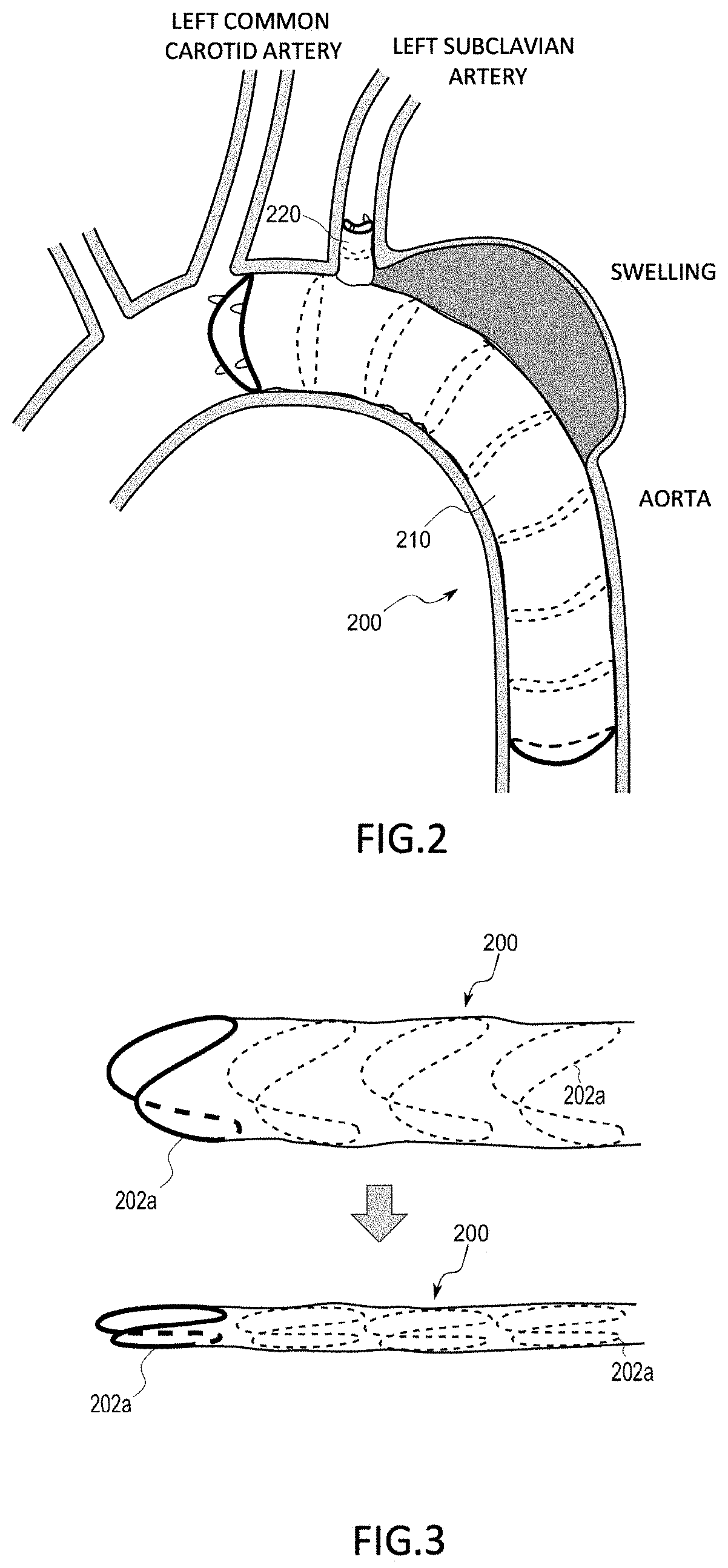 Stent graft transport device