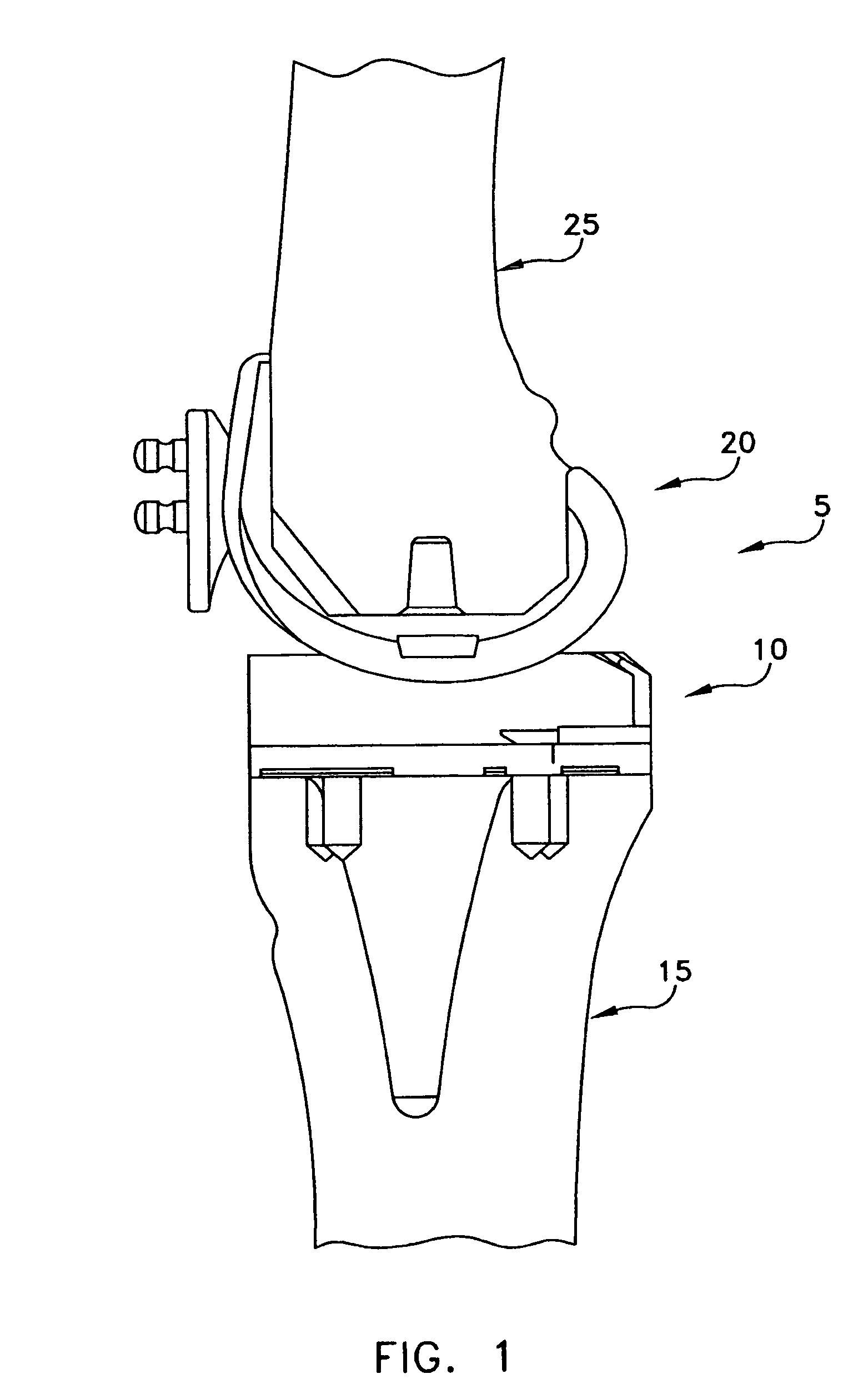 Bimetal tibial component construct for knee joint prosthesis
