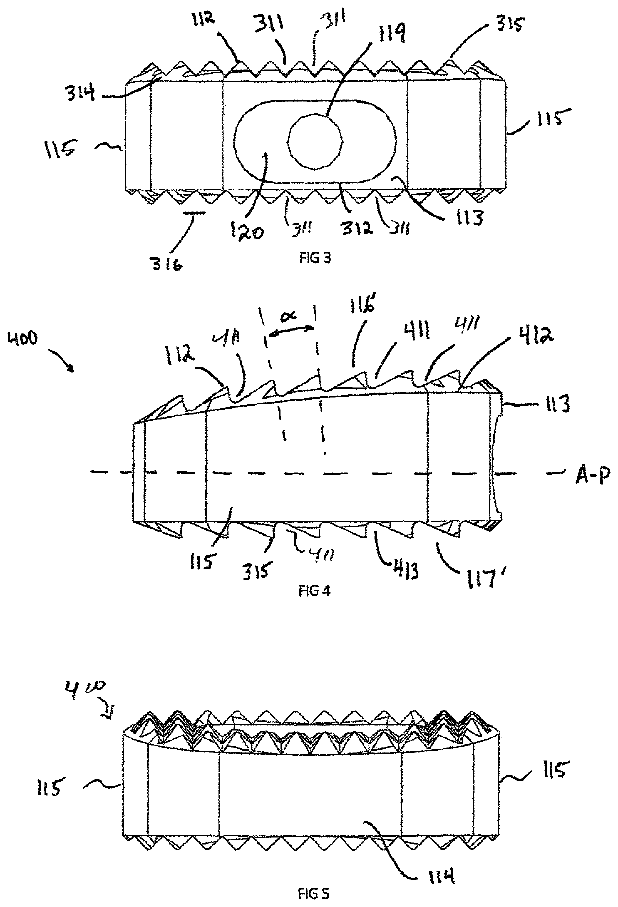 Wedge osteotomy device and method of use