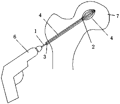 Bone pulverizer for femoral head internal necrosis