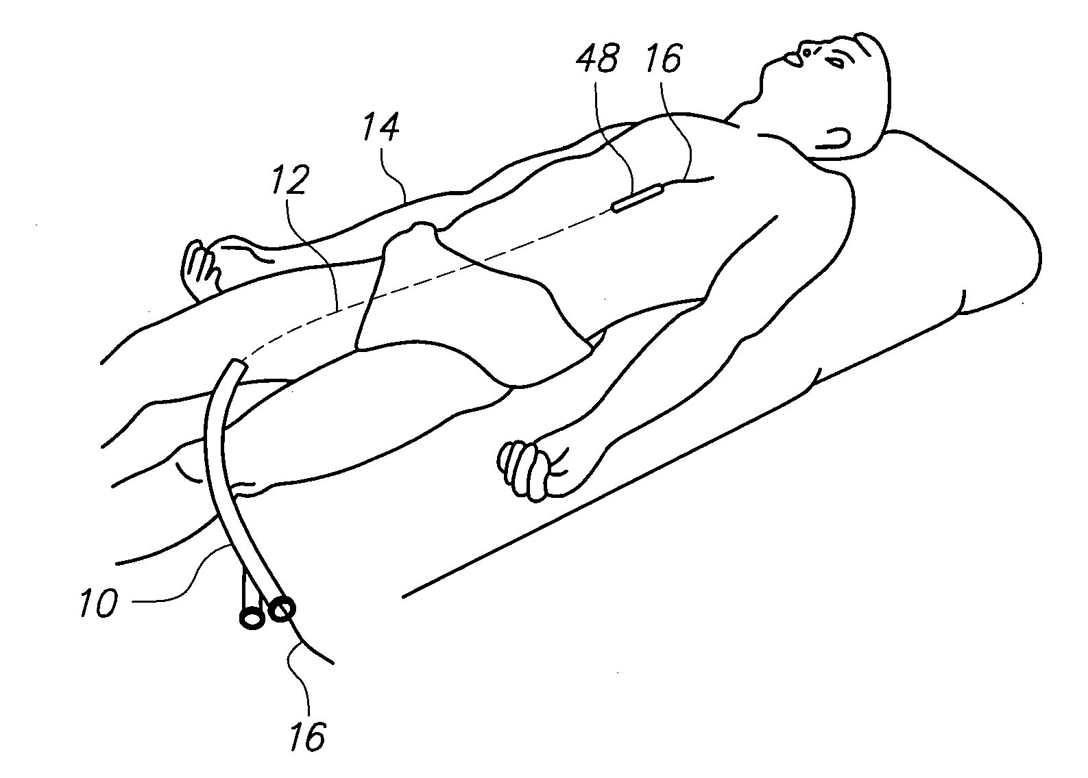Over-the-wire catheter with lateral access