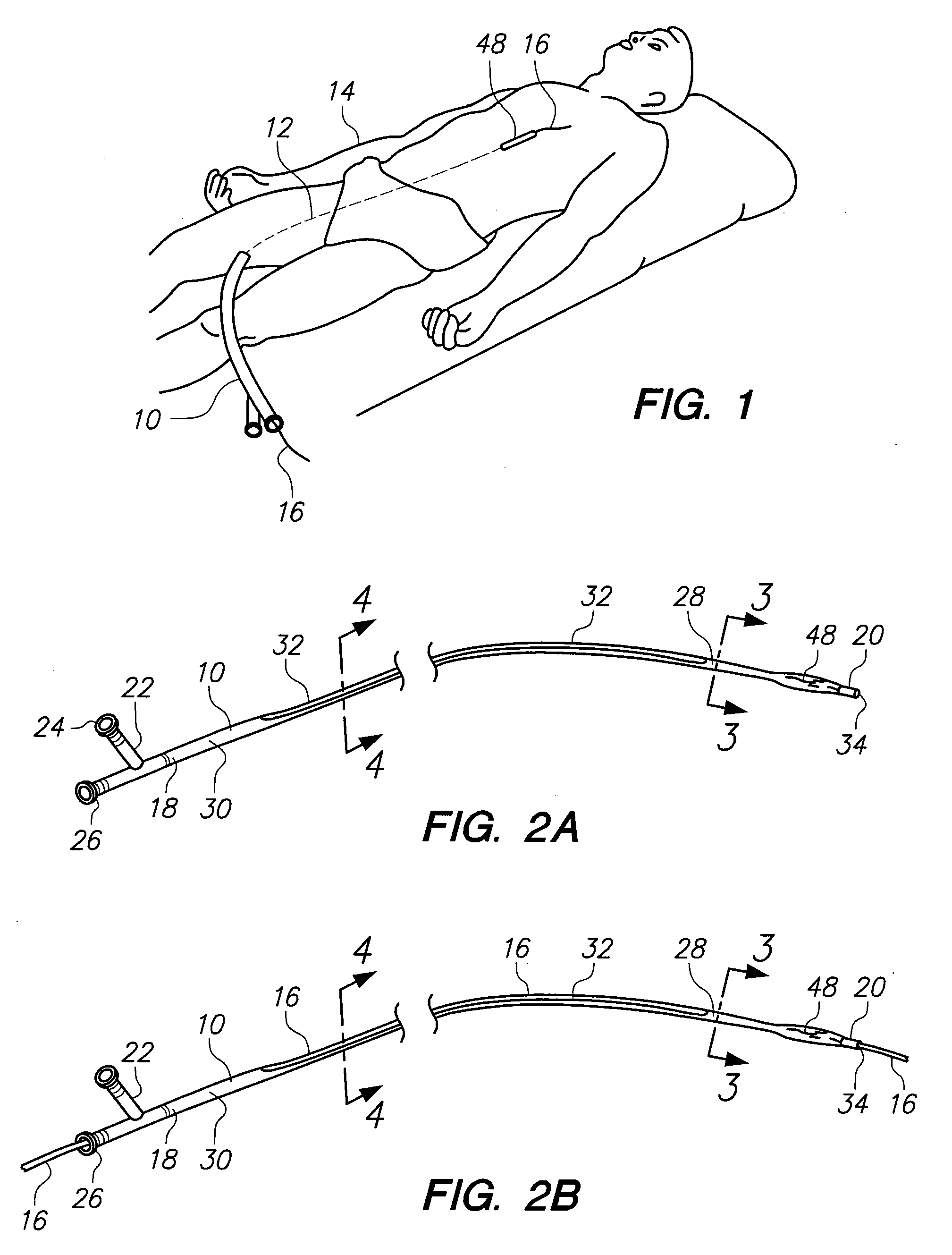 Over-the-wire catheter with lateral access