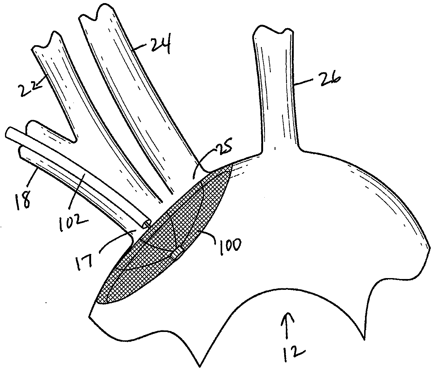 Methods of reducing embolism to cerebral circulation as a consequence of an index cardiac procedure