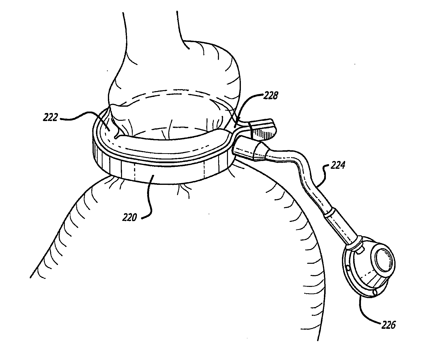Method for modulating changes in intra-band pressure in a gastric band