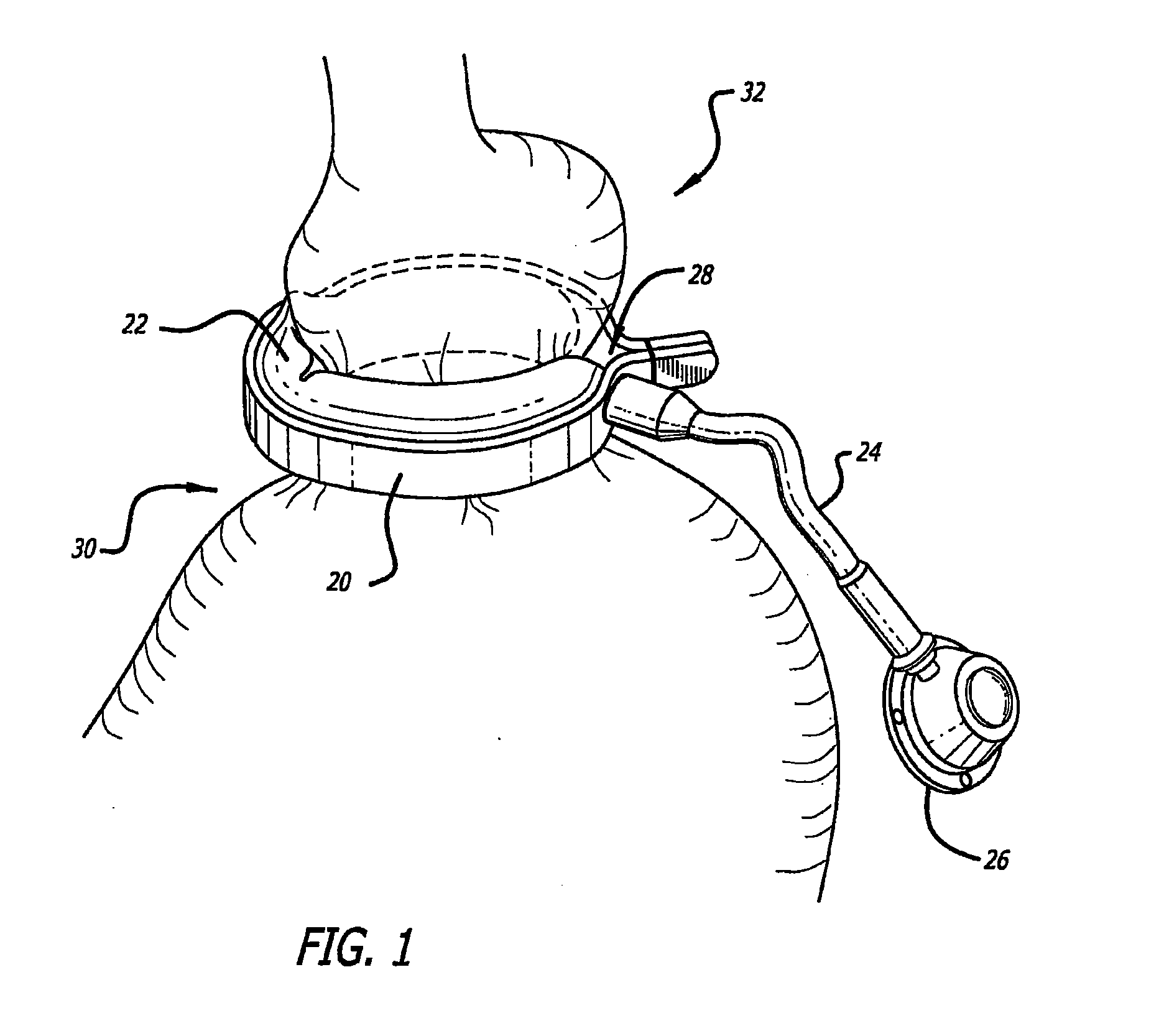 Method for modulating changes in intra-band pressure in a gastric band