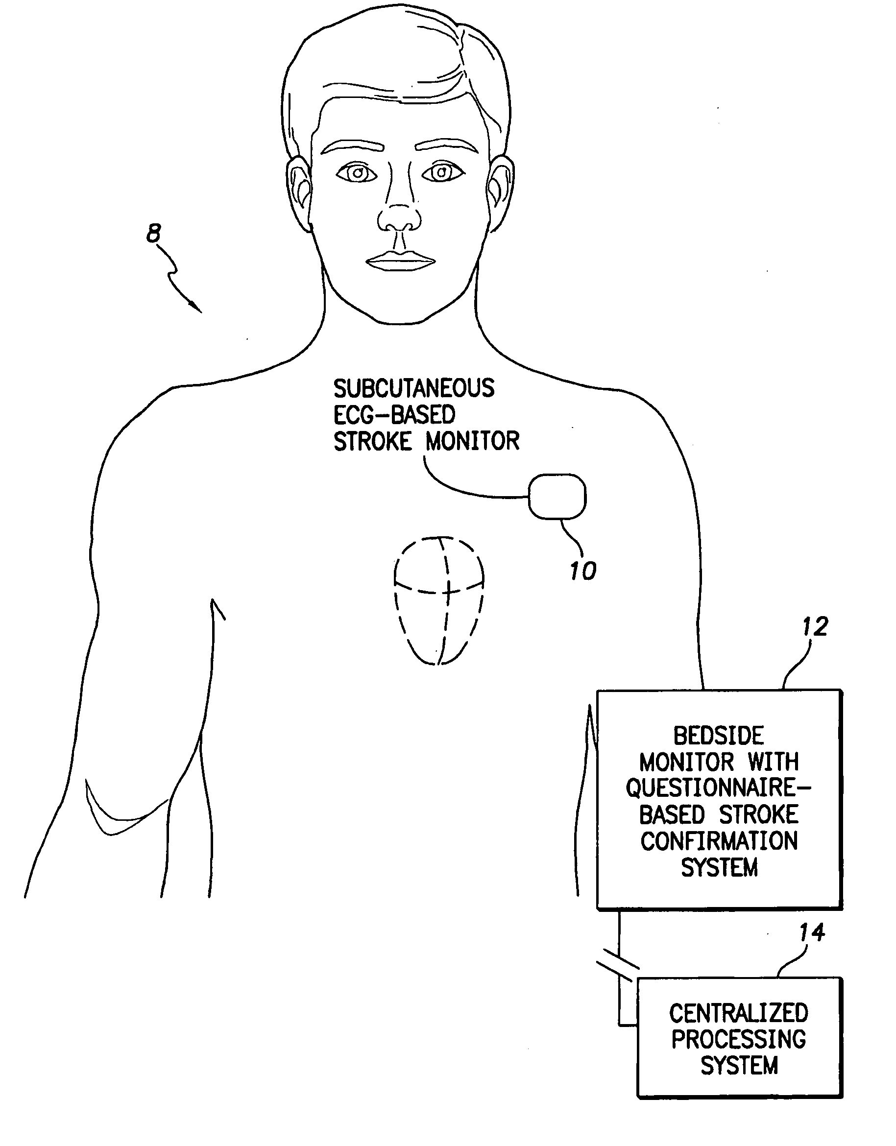 Systems and Methods for Use with an Implantable Medical Device for Detecting Stroke Based on Electrocardiac Signals
