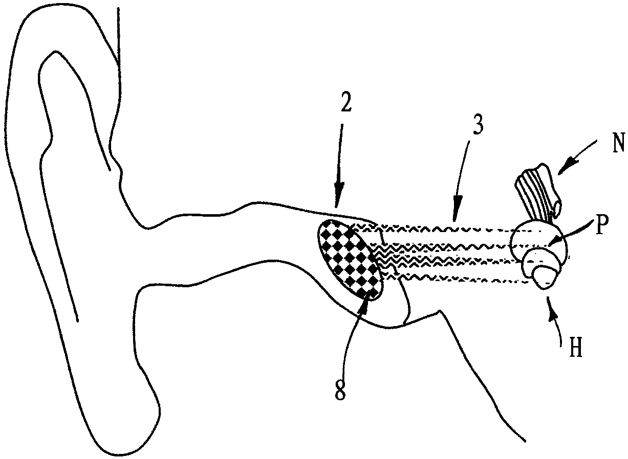 Hearing prosthesis emitting ultrasonic pulses