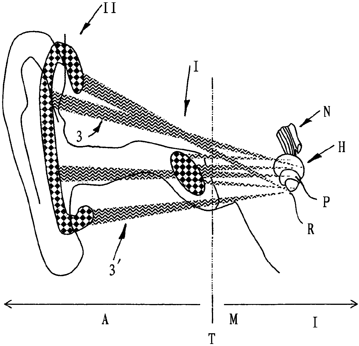 Hearing prosthesis emitting ultrasonic pulses