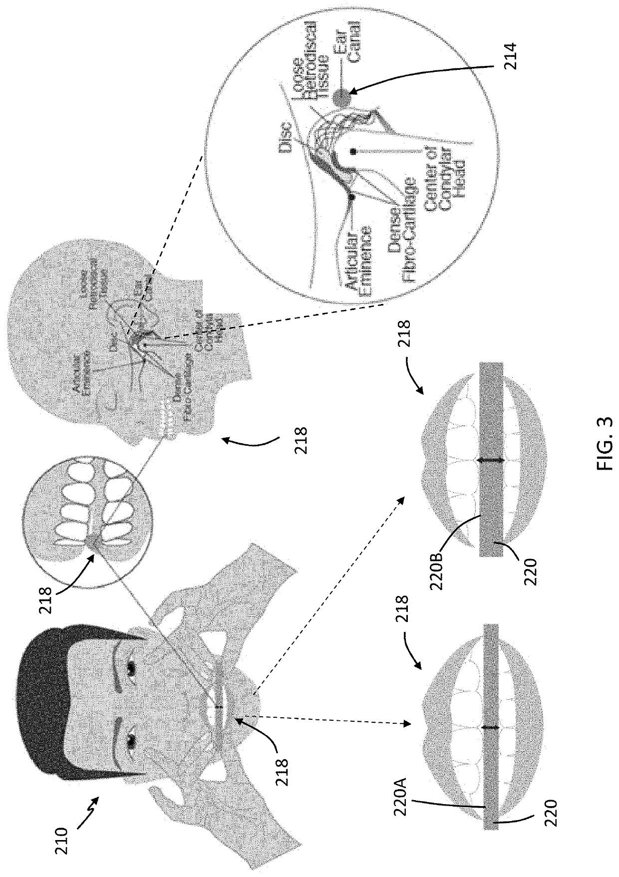 Systems, apparatuses, and methods for diagnosis and treatment of temporomandibular disorders (TMD)