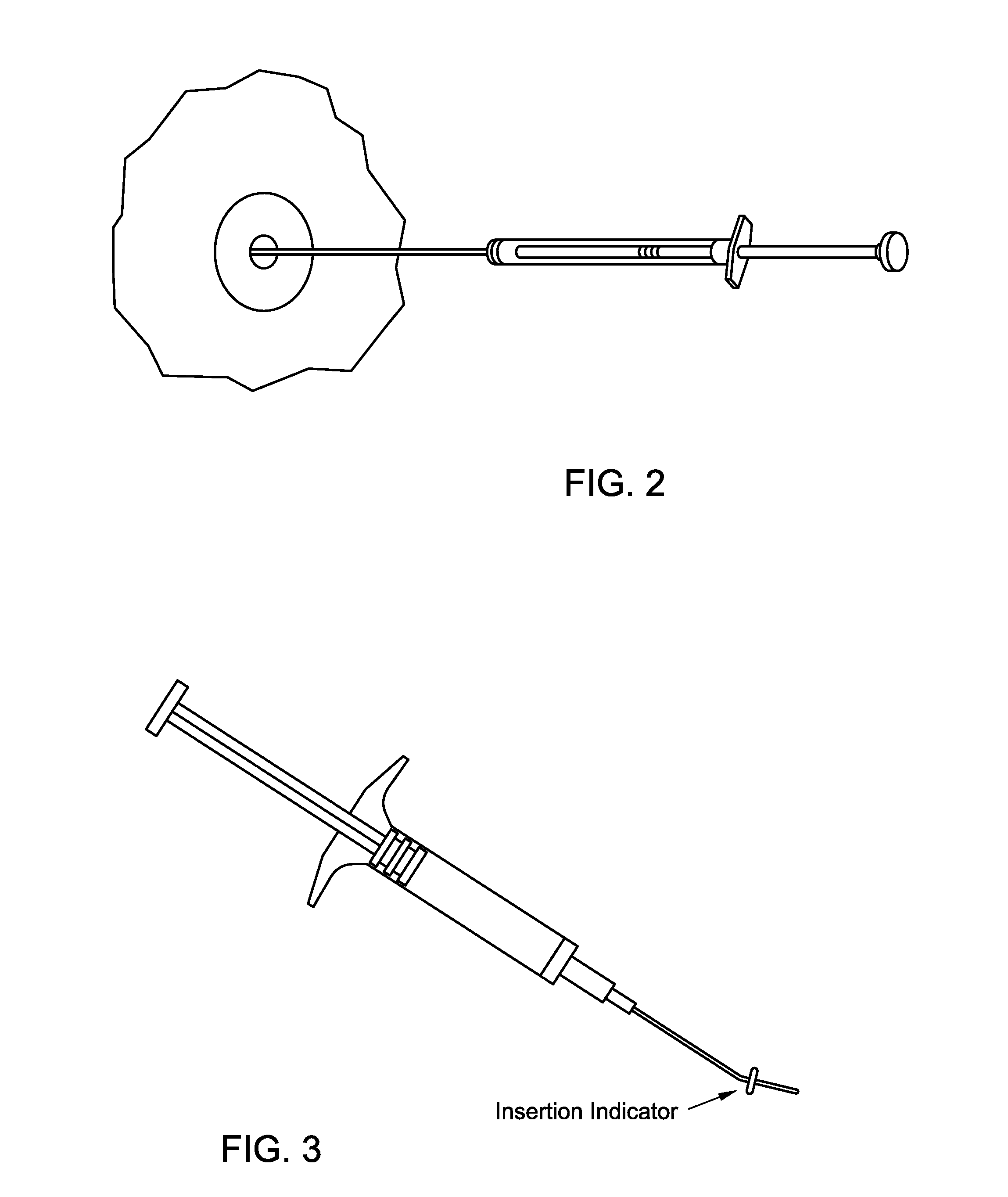 Method for treating otic infections after tympanostomy tube placement