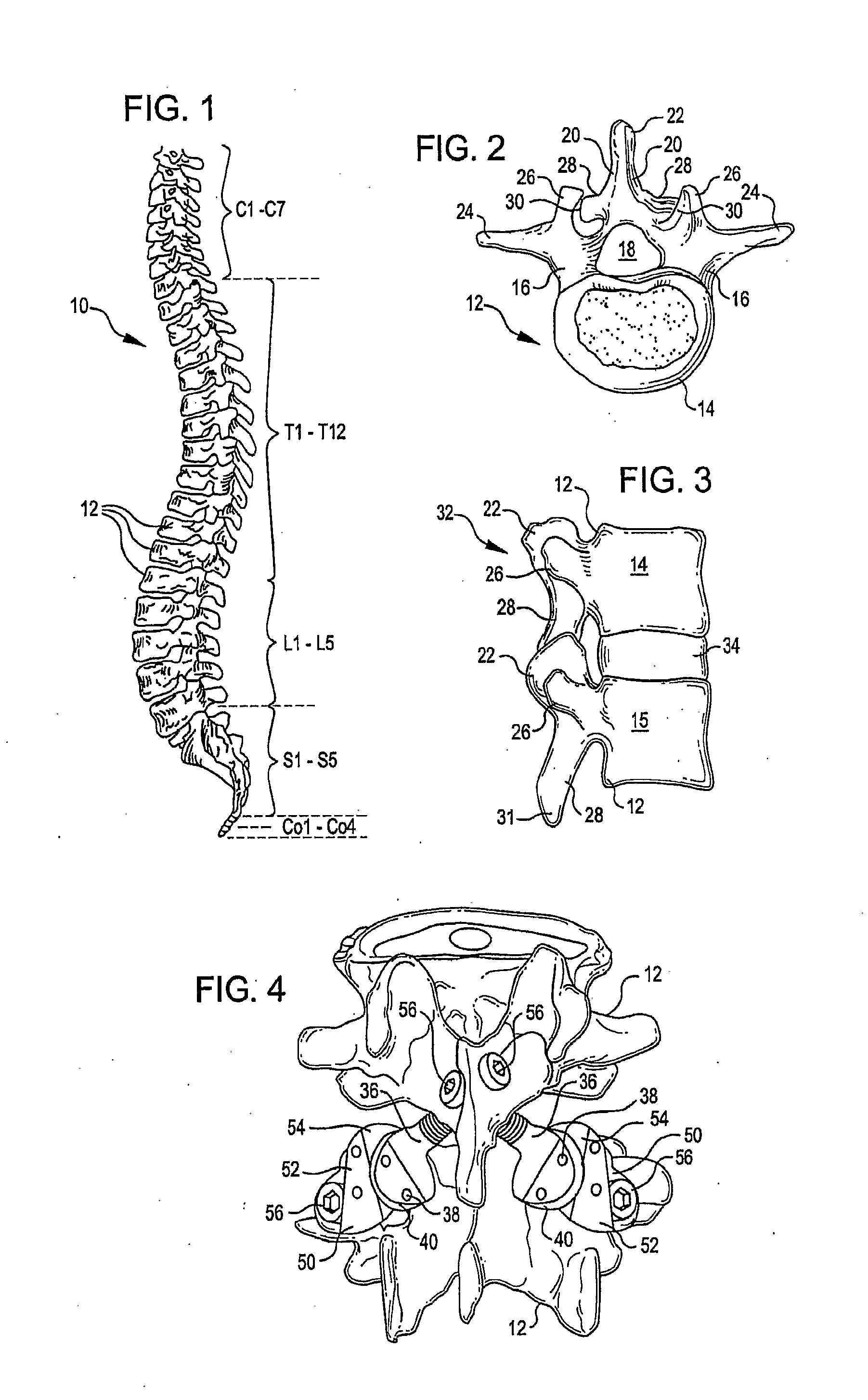 Crossbar spinal prosthesis having a modular design and systems for treating spinal pathologies