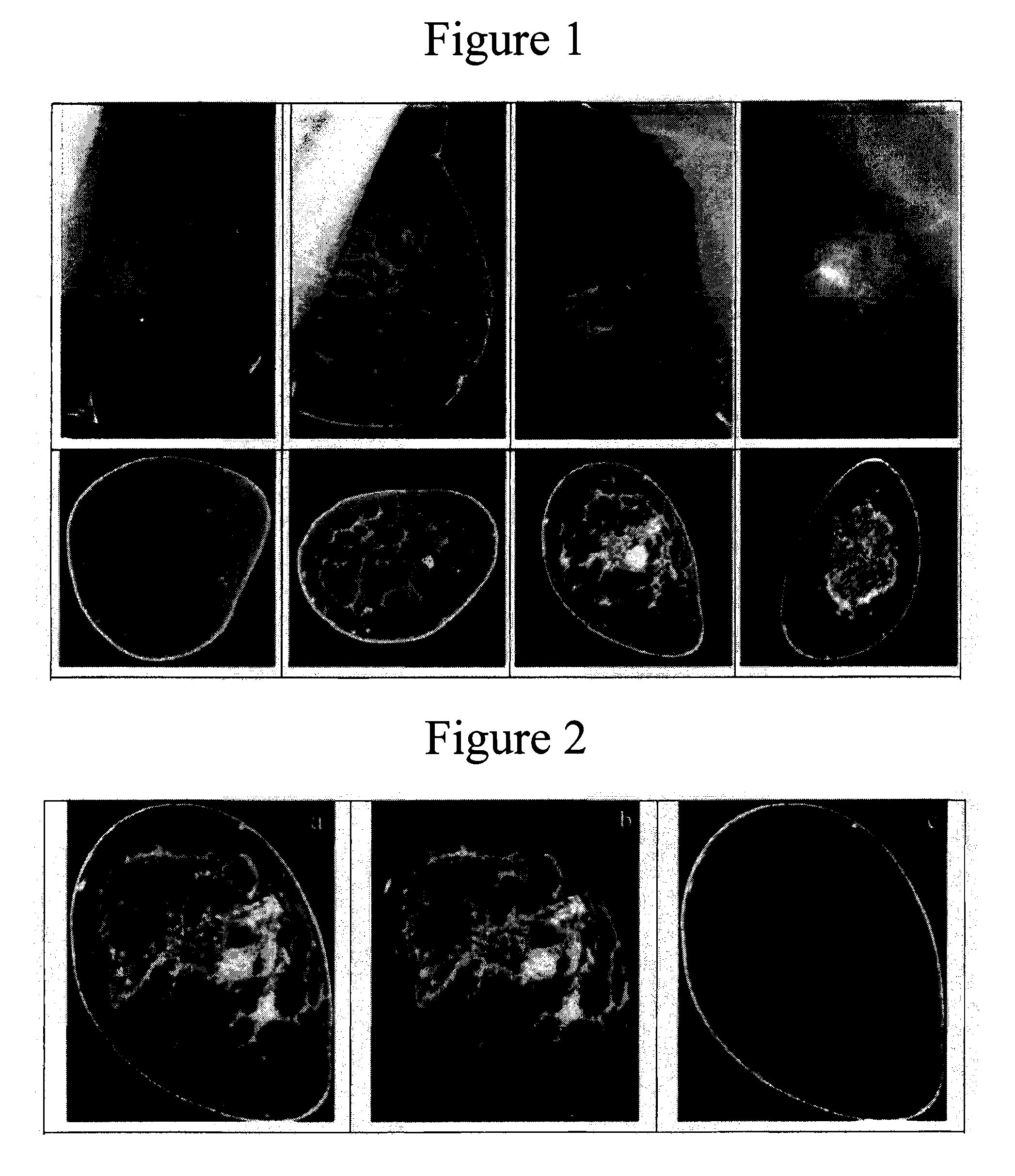 Method and apparatus for cone beam breast CT image-based computer-aided detection and diagnosis