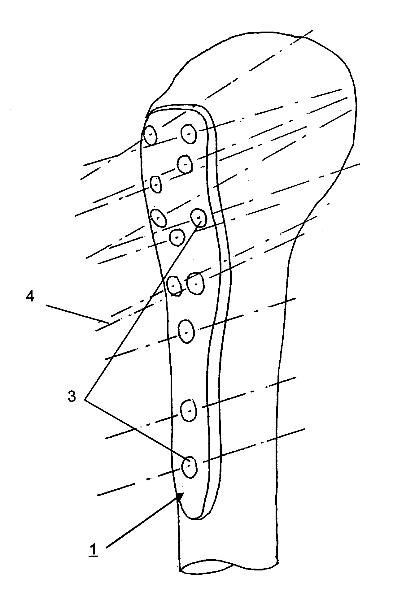 Method for designing and/or optimizing a surgical device