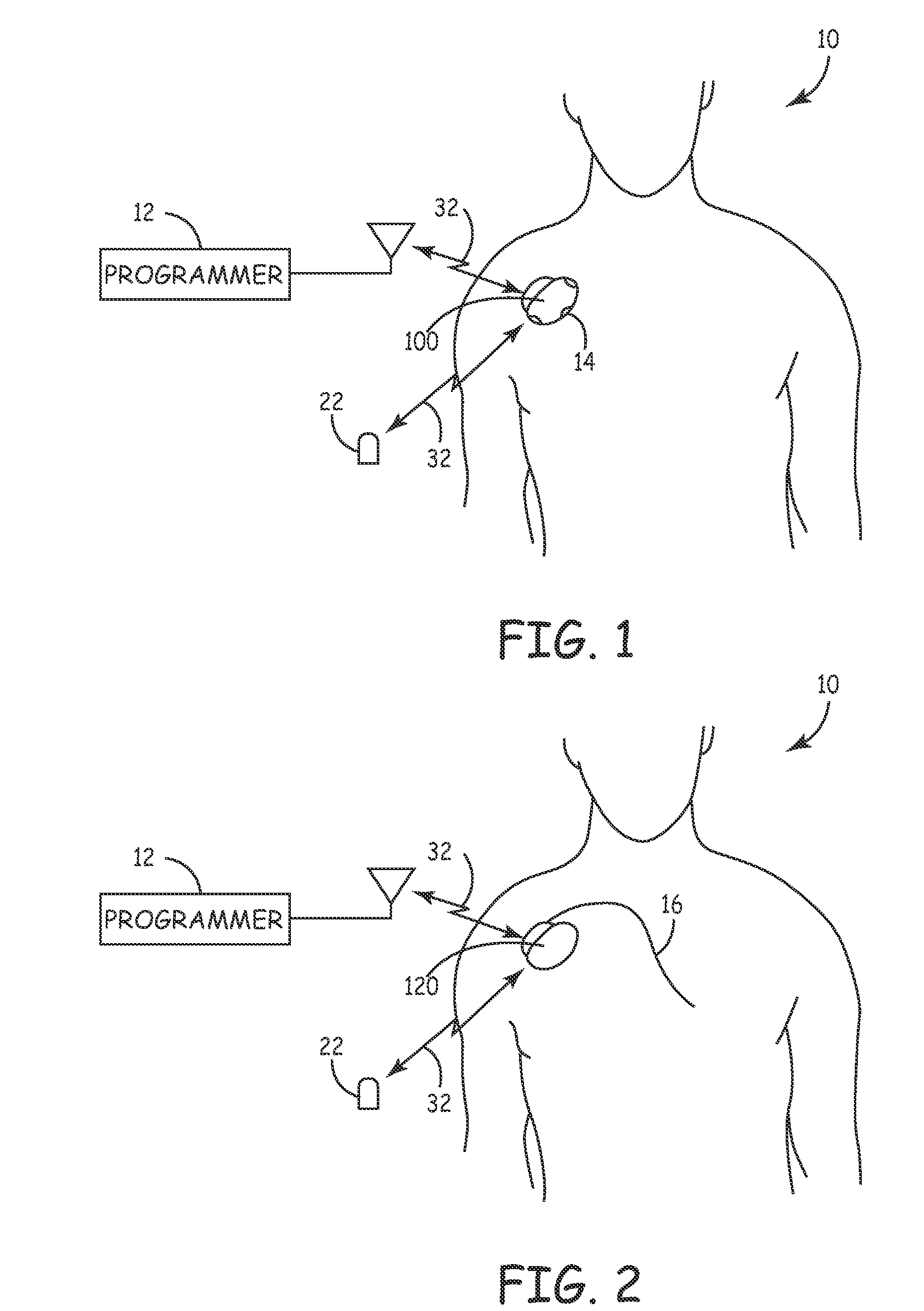 System and method for monitoring cardiac signal activity in patients with nervous system disorders